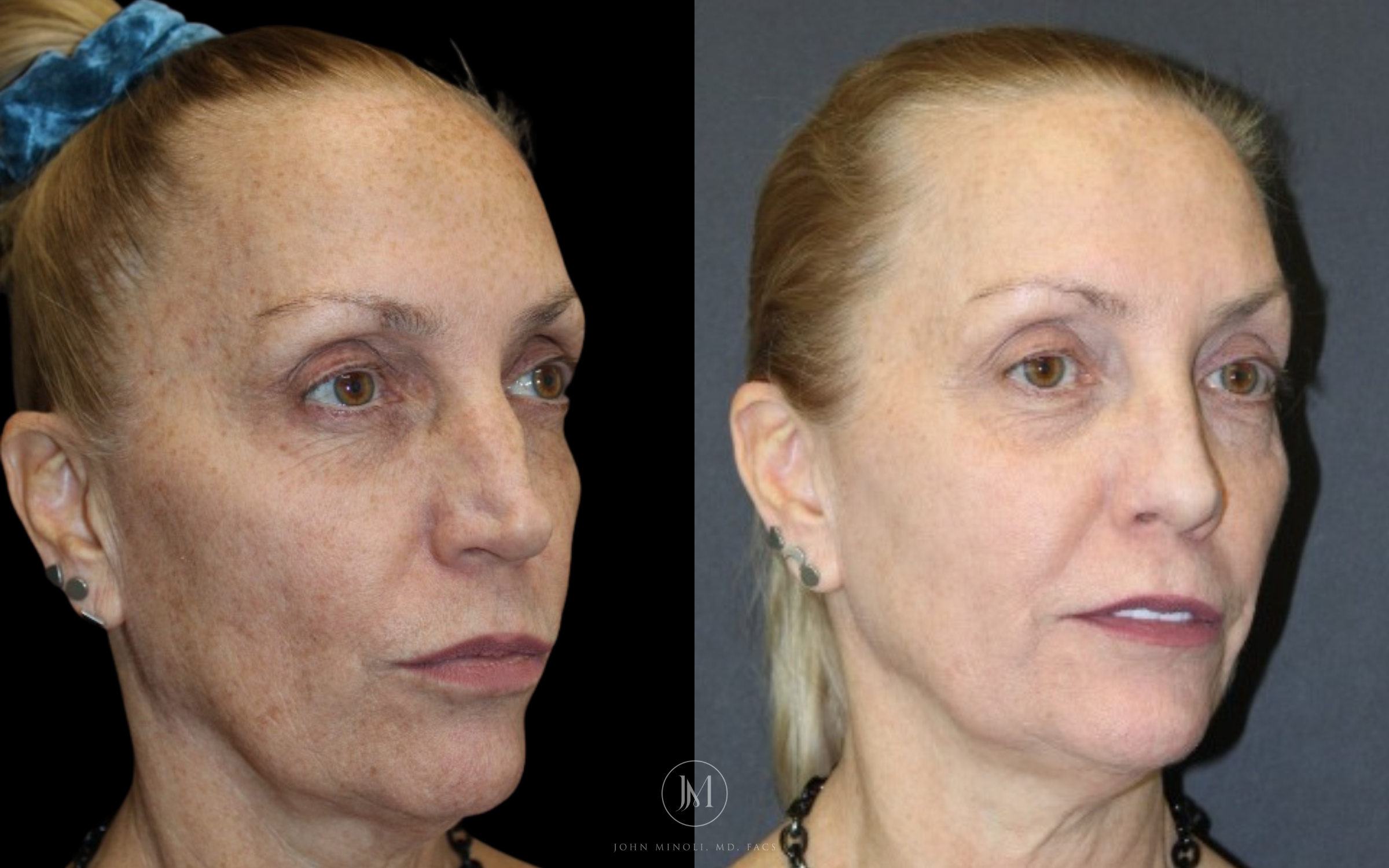 Revision Rhinoplasty Before and After