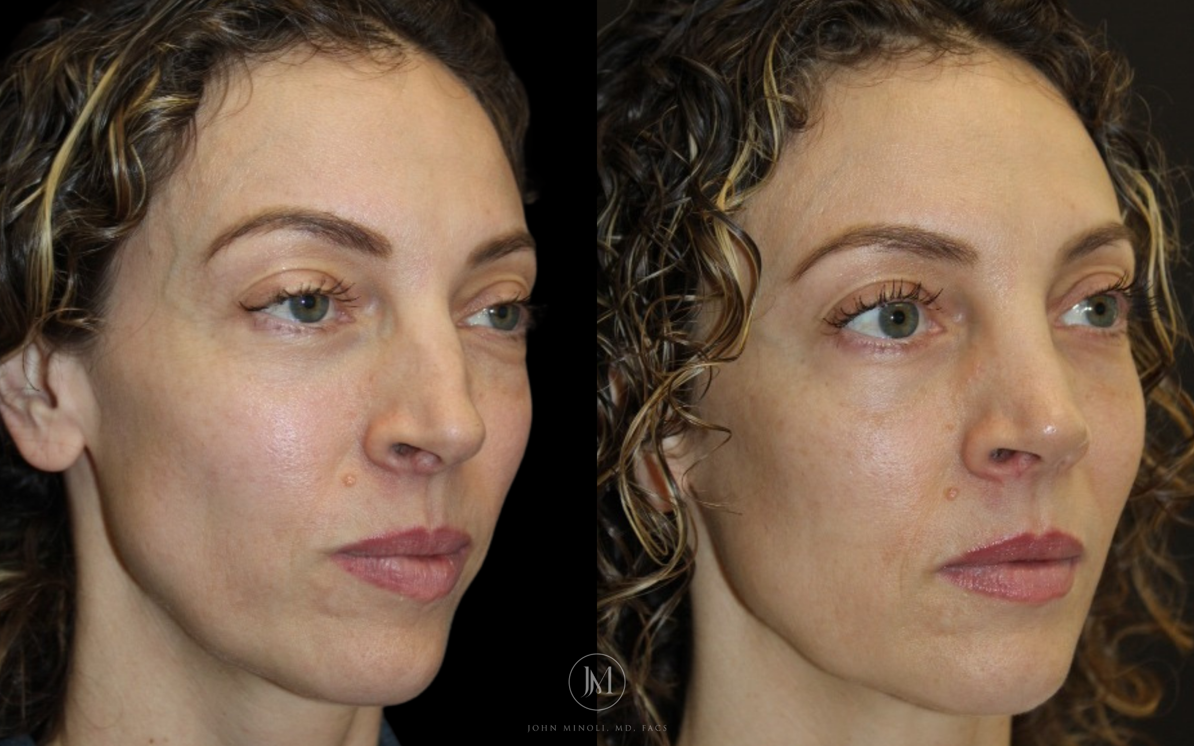 Primary Rhinoplasty before and after