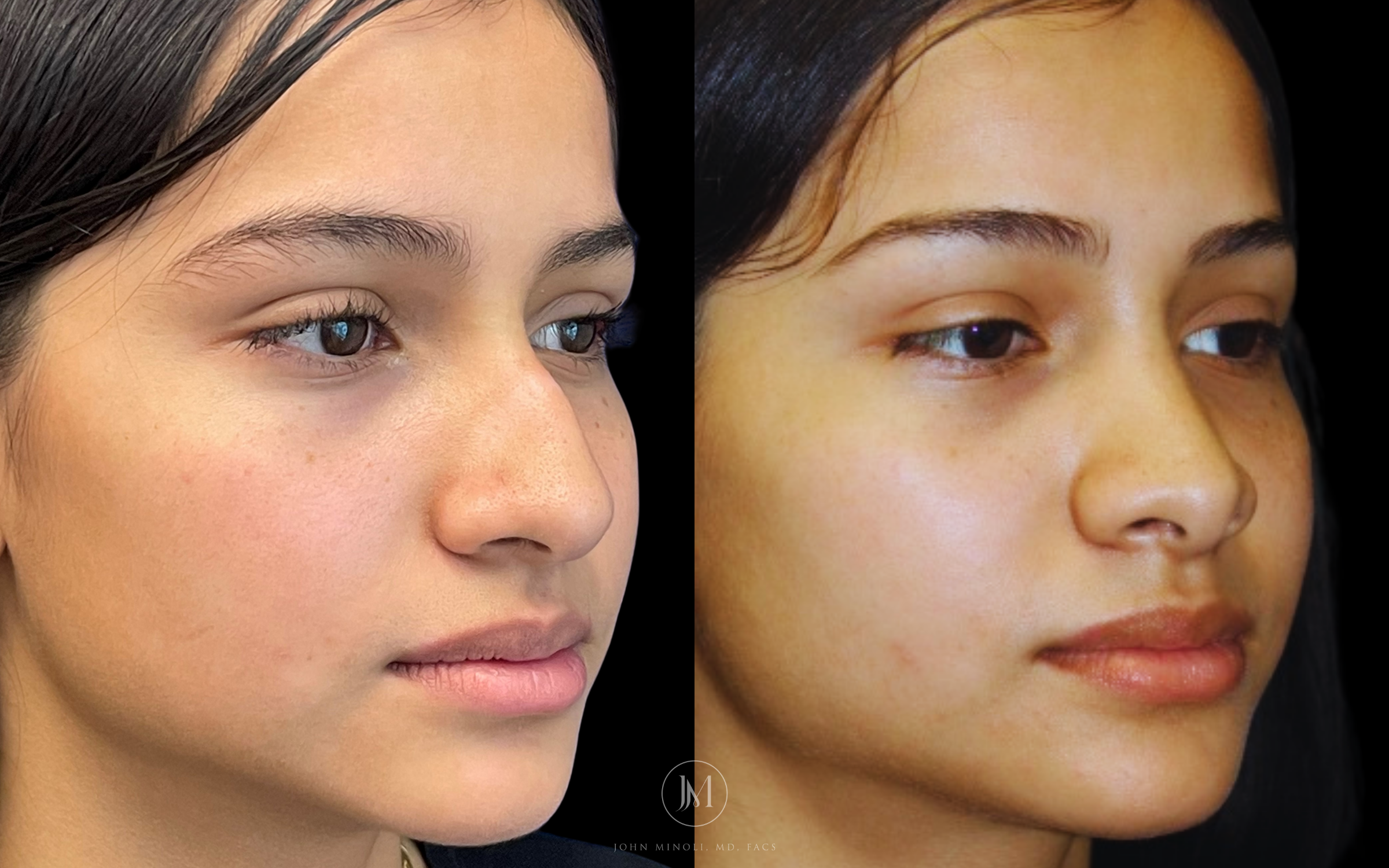 Primary Rhinoplasty before and after