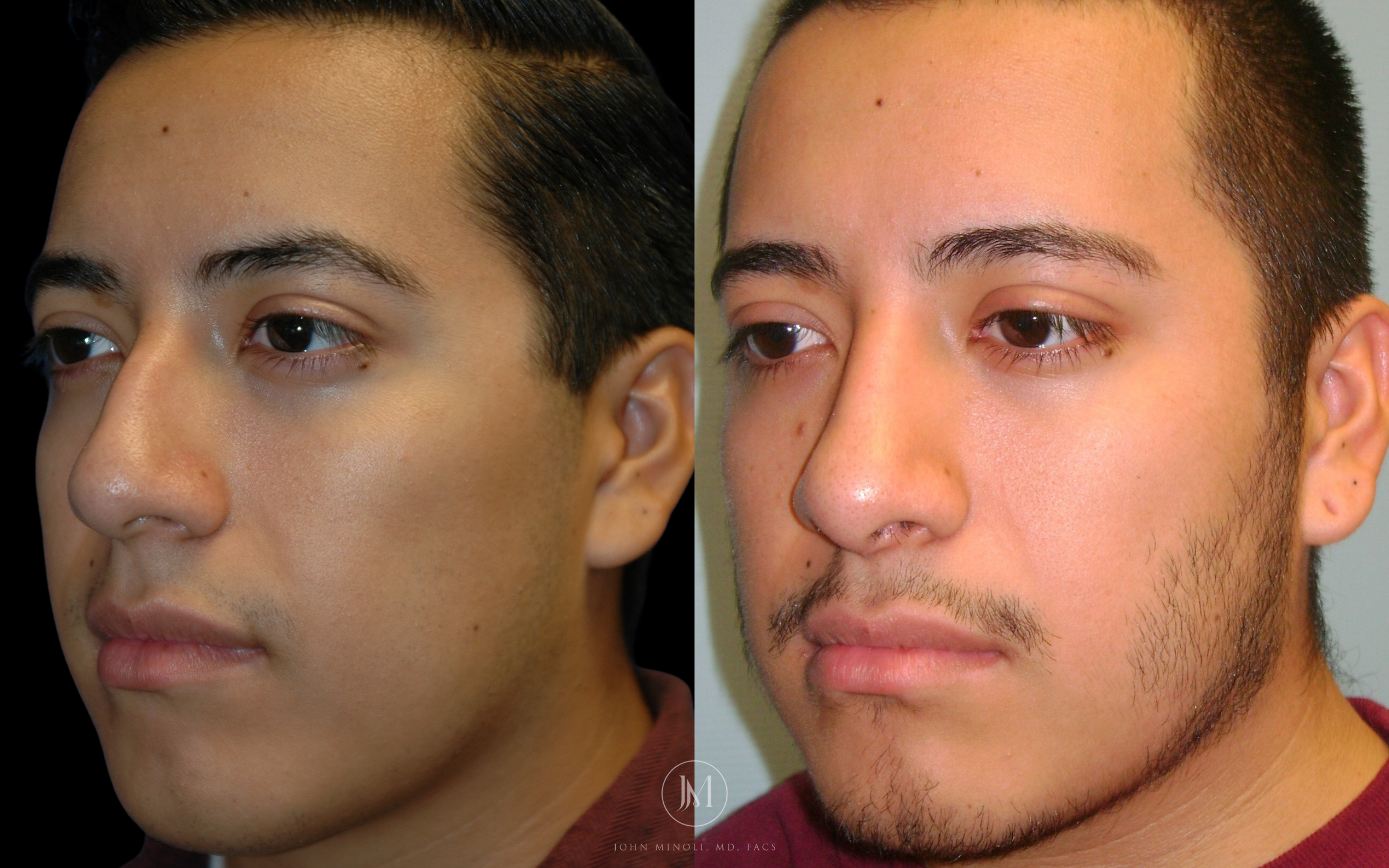 Primary Rhinoplasty before and after