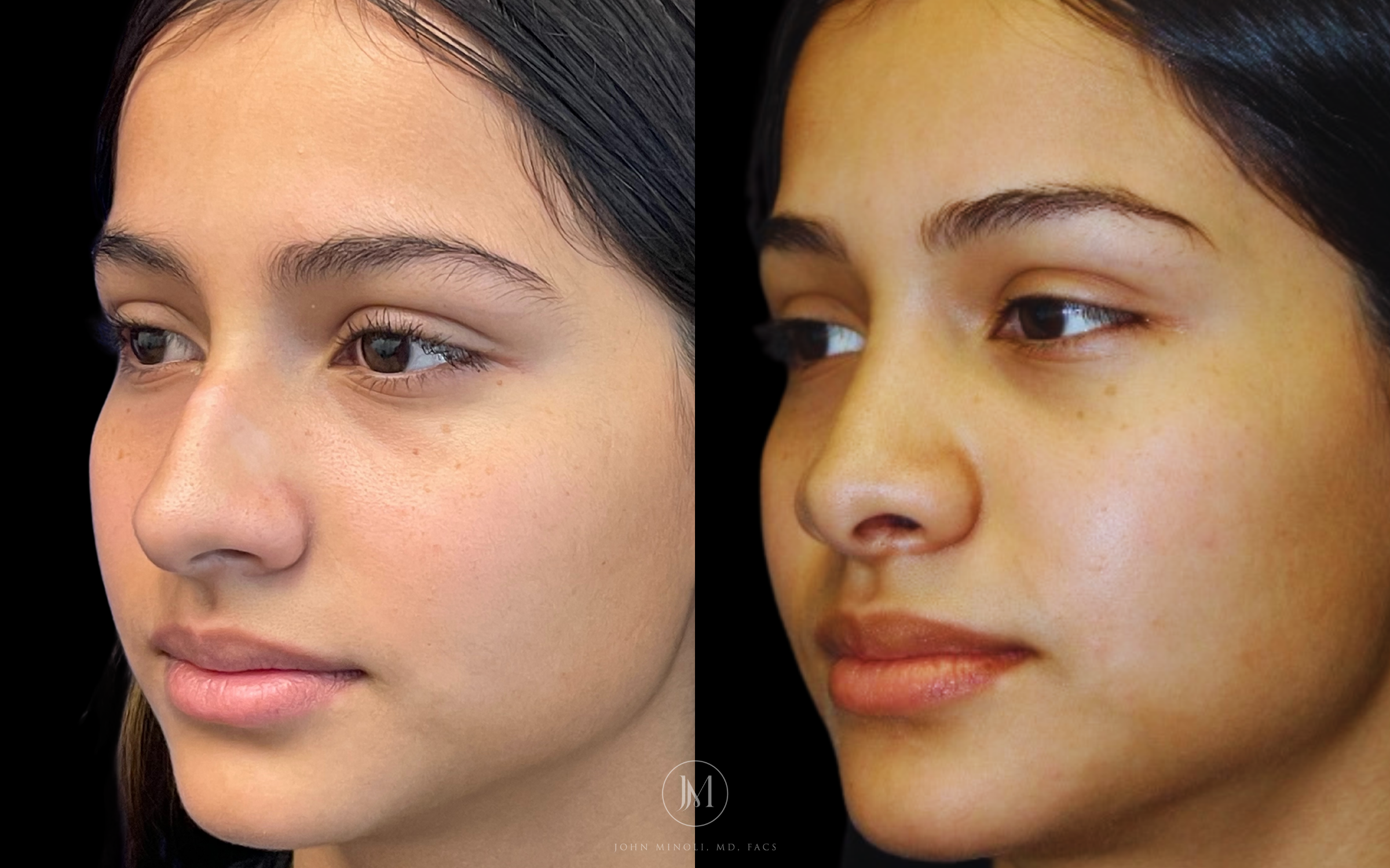 Primary Rhinoplasty before and after