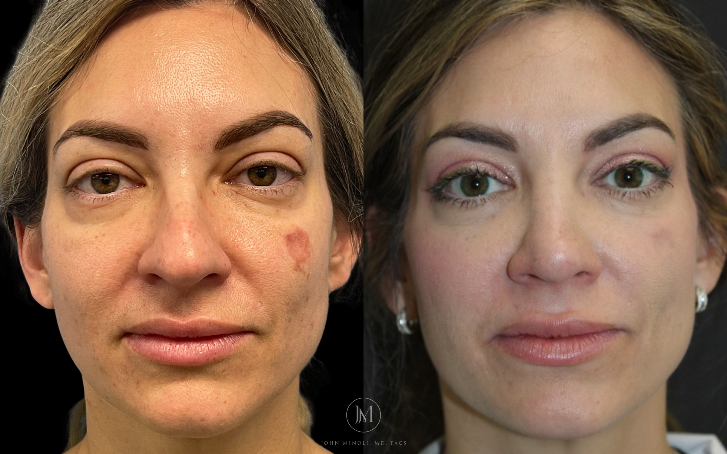 Woman Before and After rhinoplasty Front