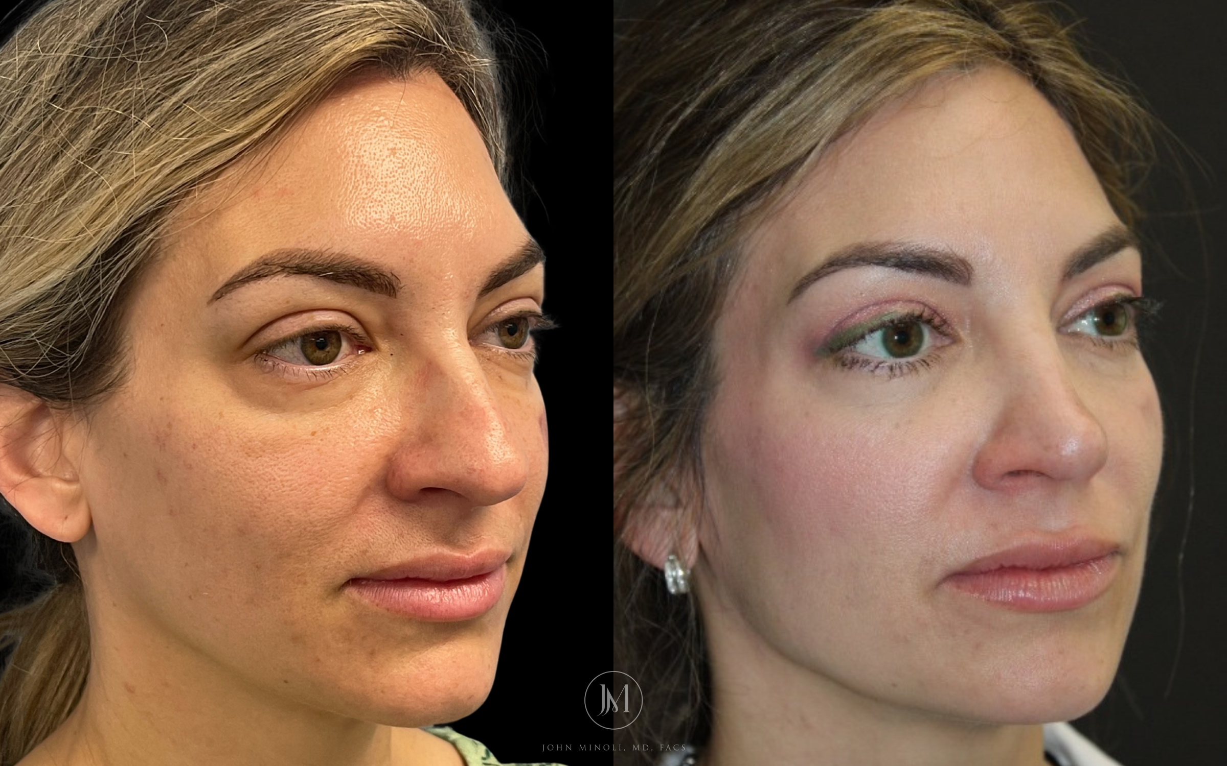 Woman Before and After rhinoplasty