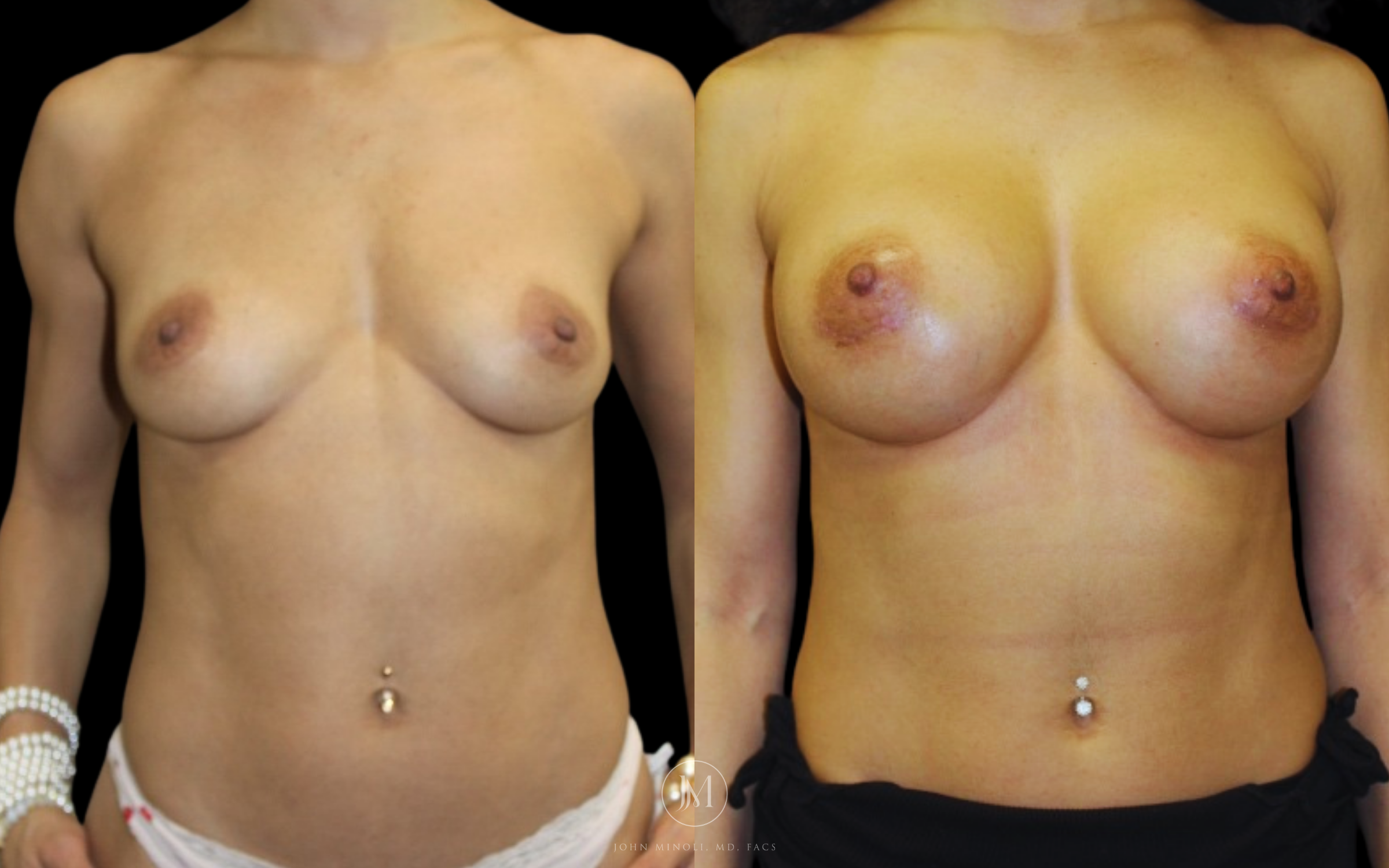 breast augmentation before and after