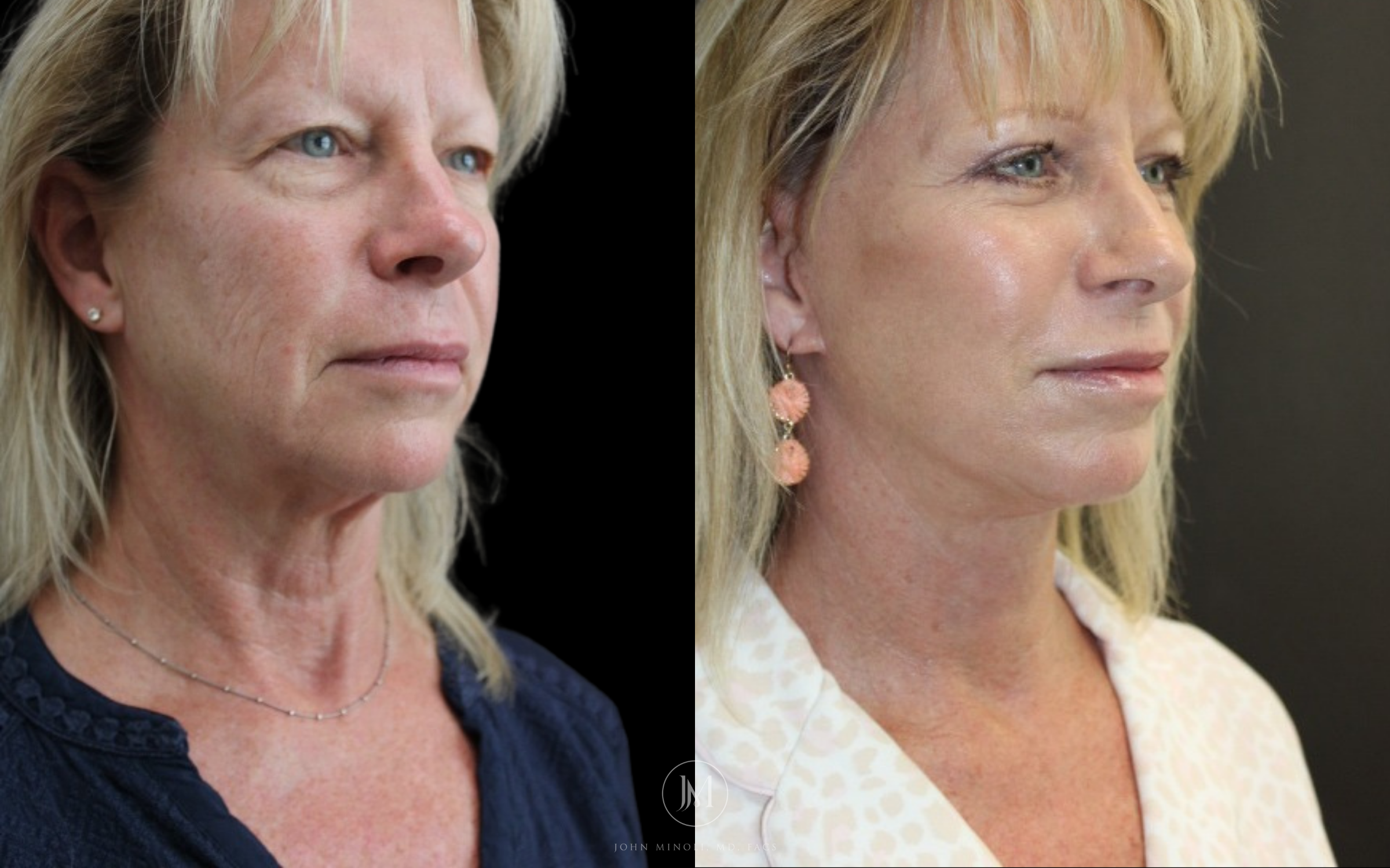 Face and Neck Lift Before and After