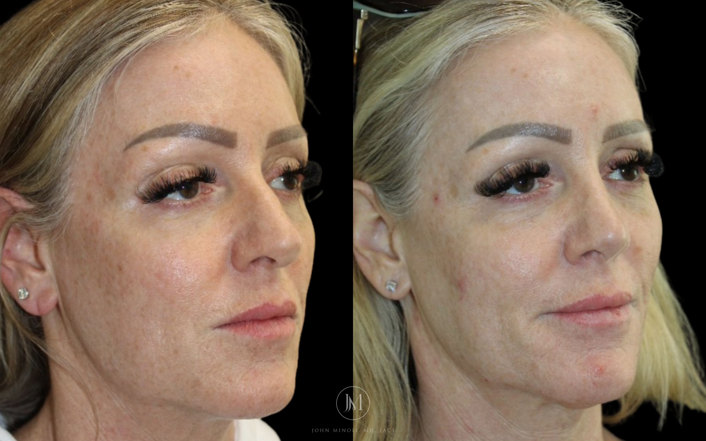 Primary Rhinoplasty B&A 45 Right