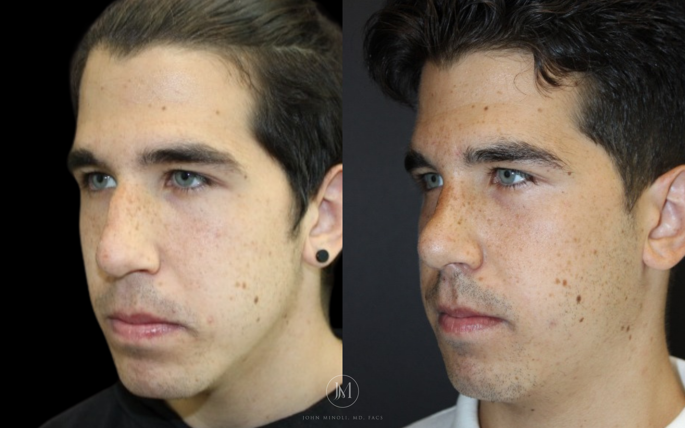 Primary Rhinoplasty before and after