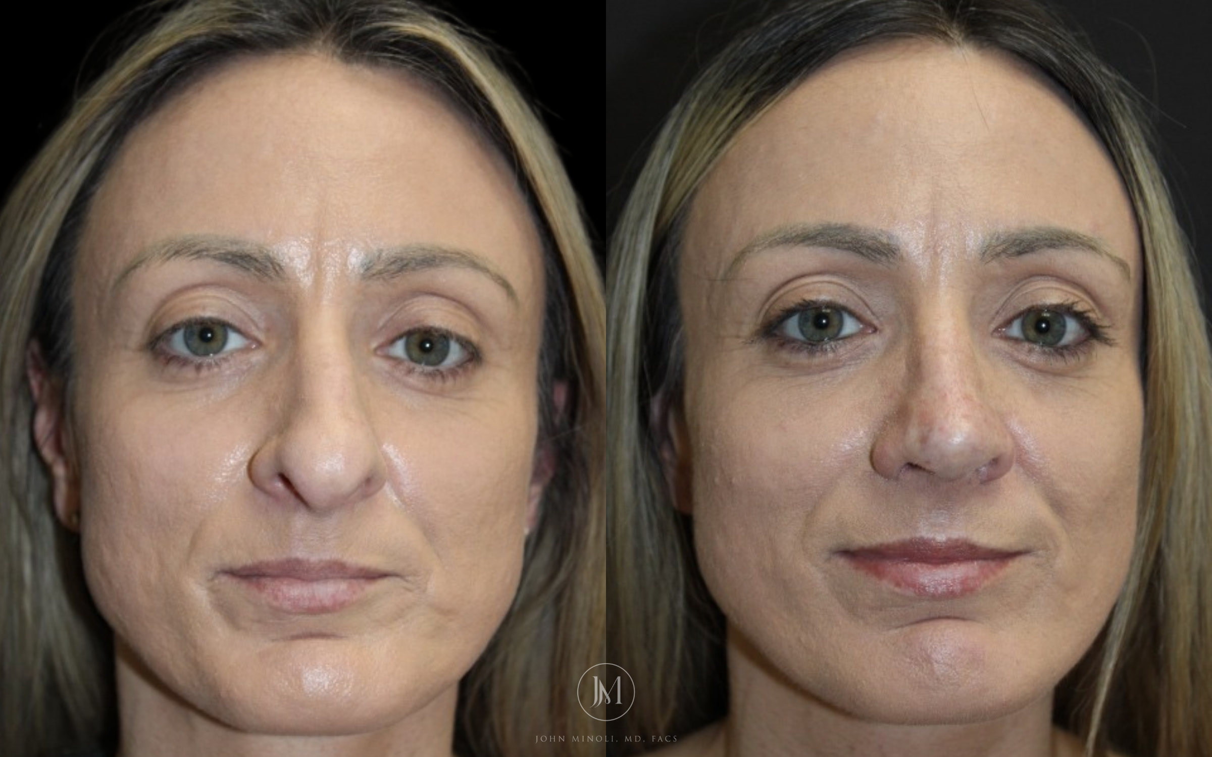 Primary Rhinoplasty before and after