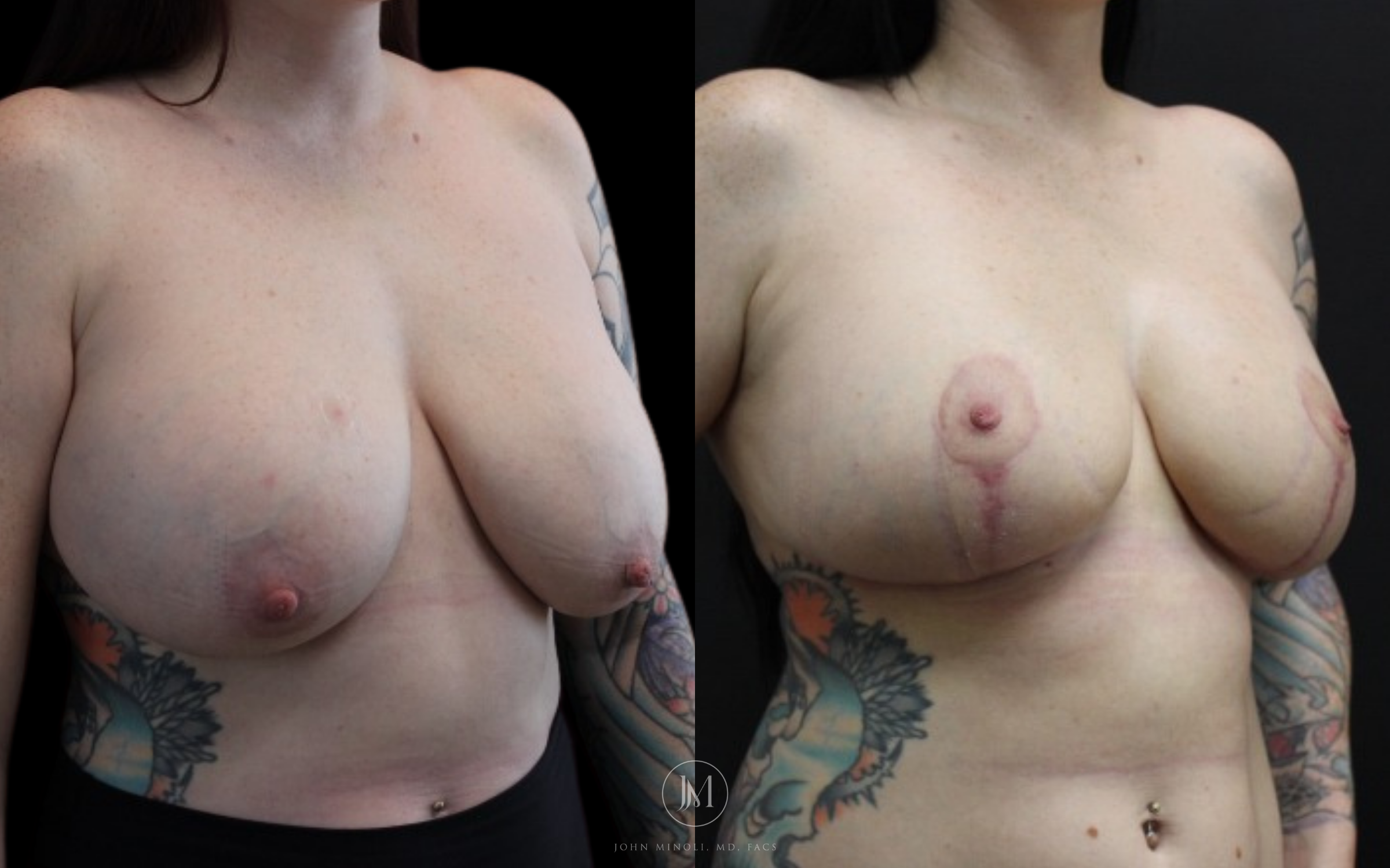 WOMAN BREAST RECONSTRUCTION  B&A