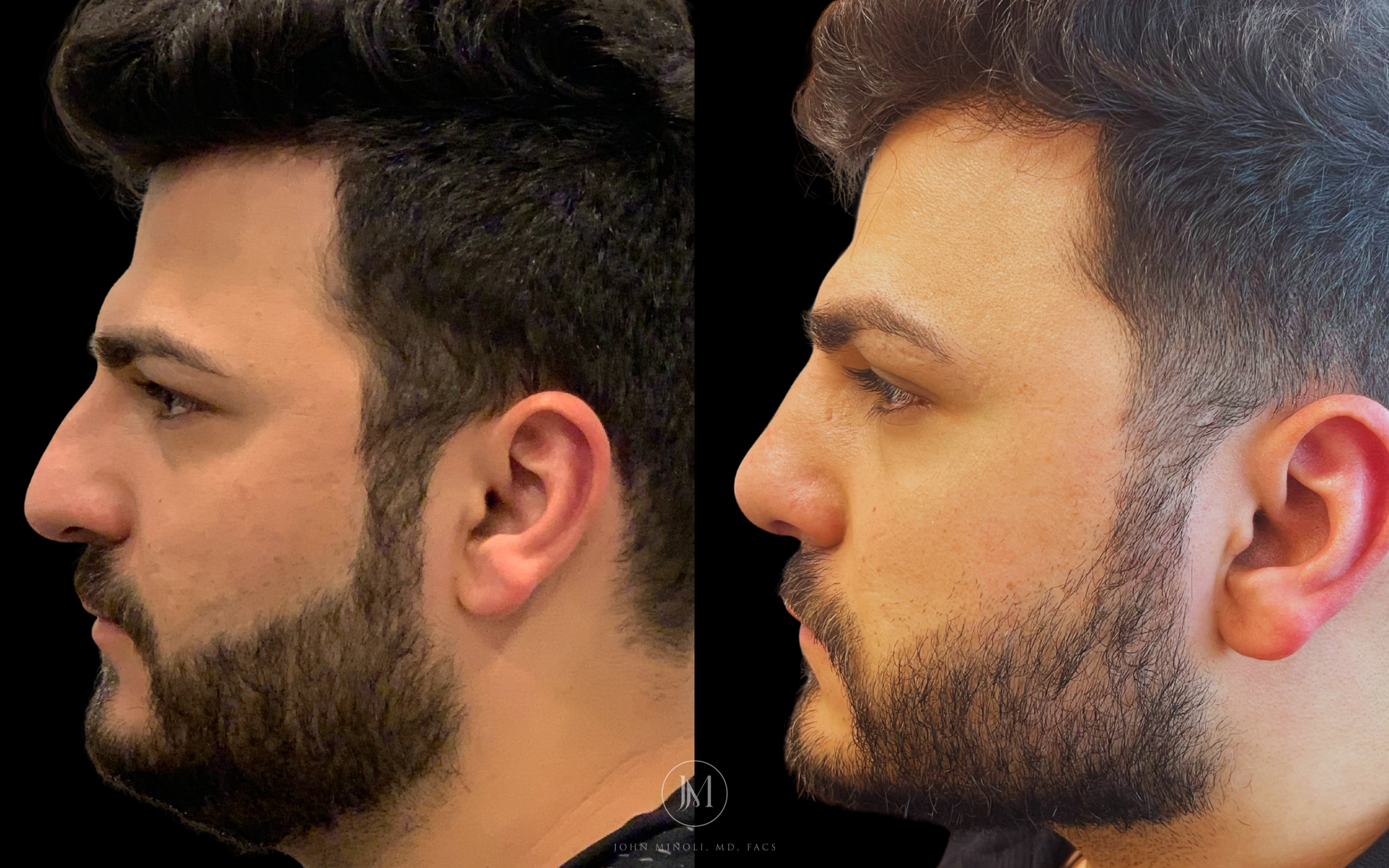 Primary Rhinoplasty before and after