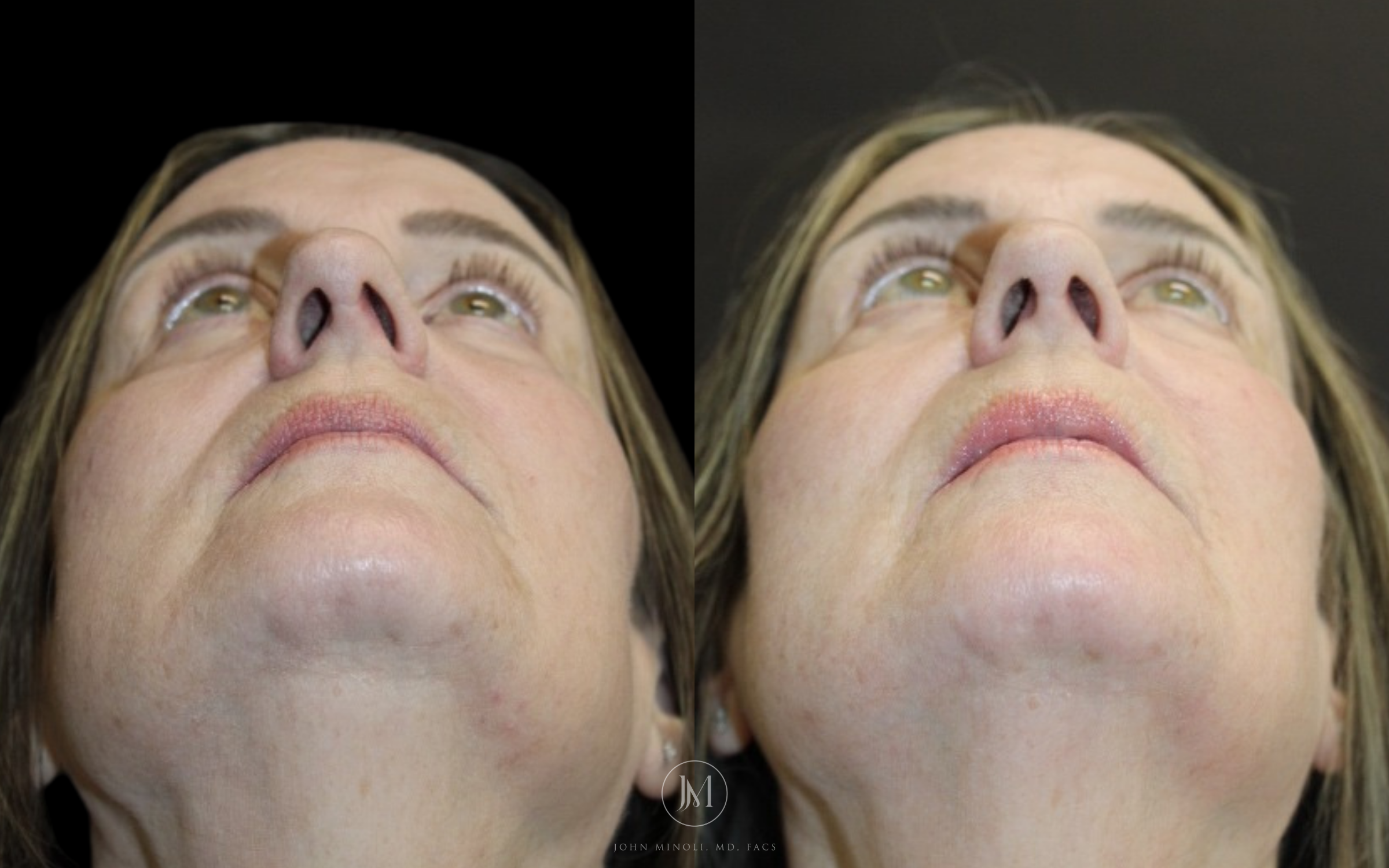 Primary Rhinoplasty before and after