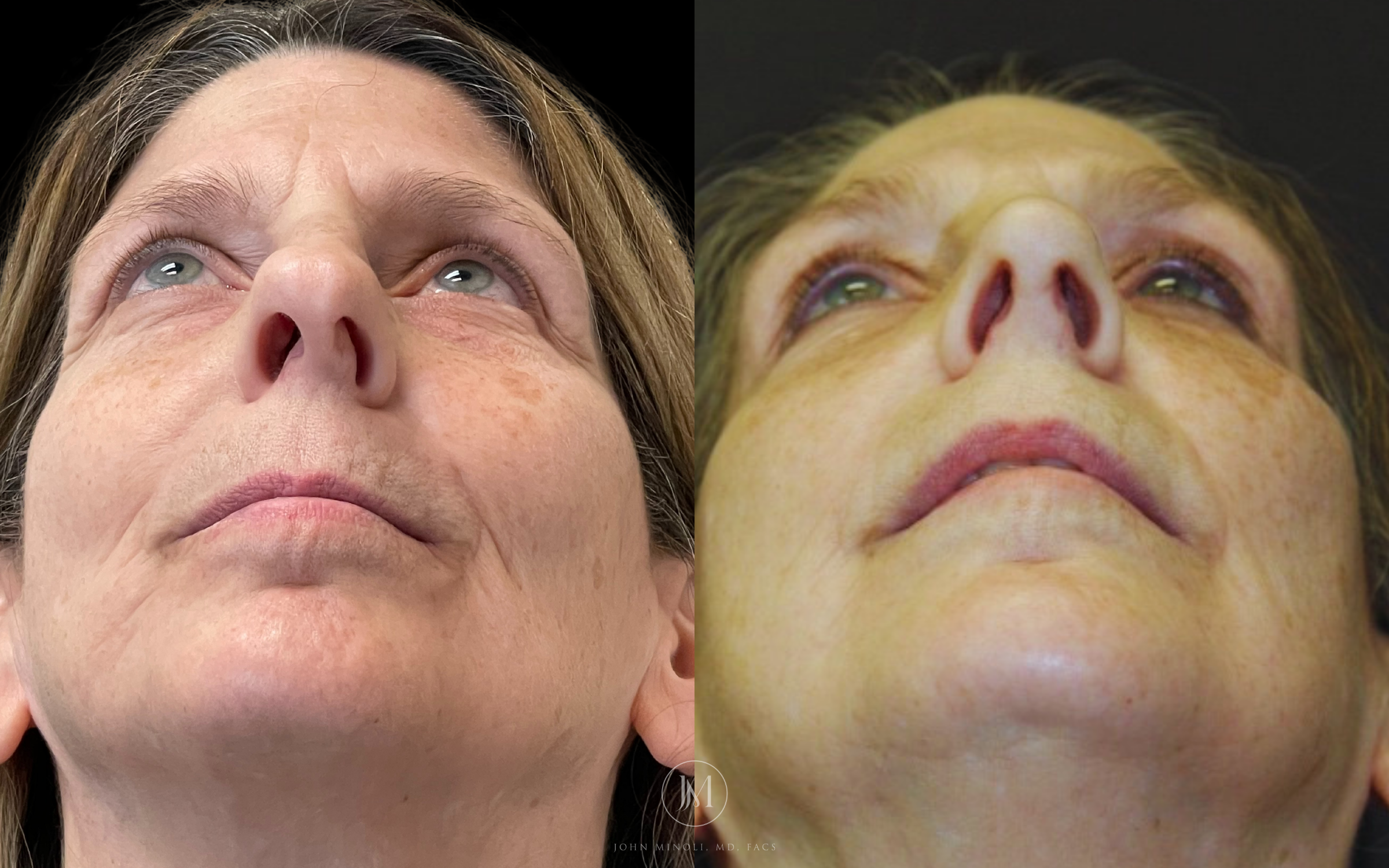 Primary Rhinoplasty before and after