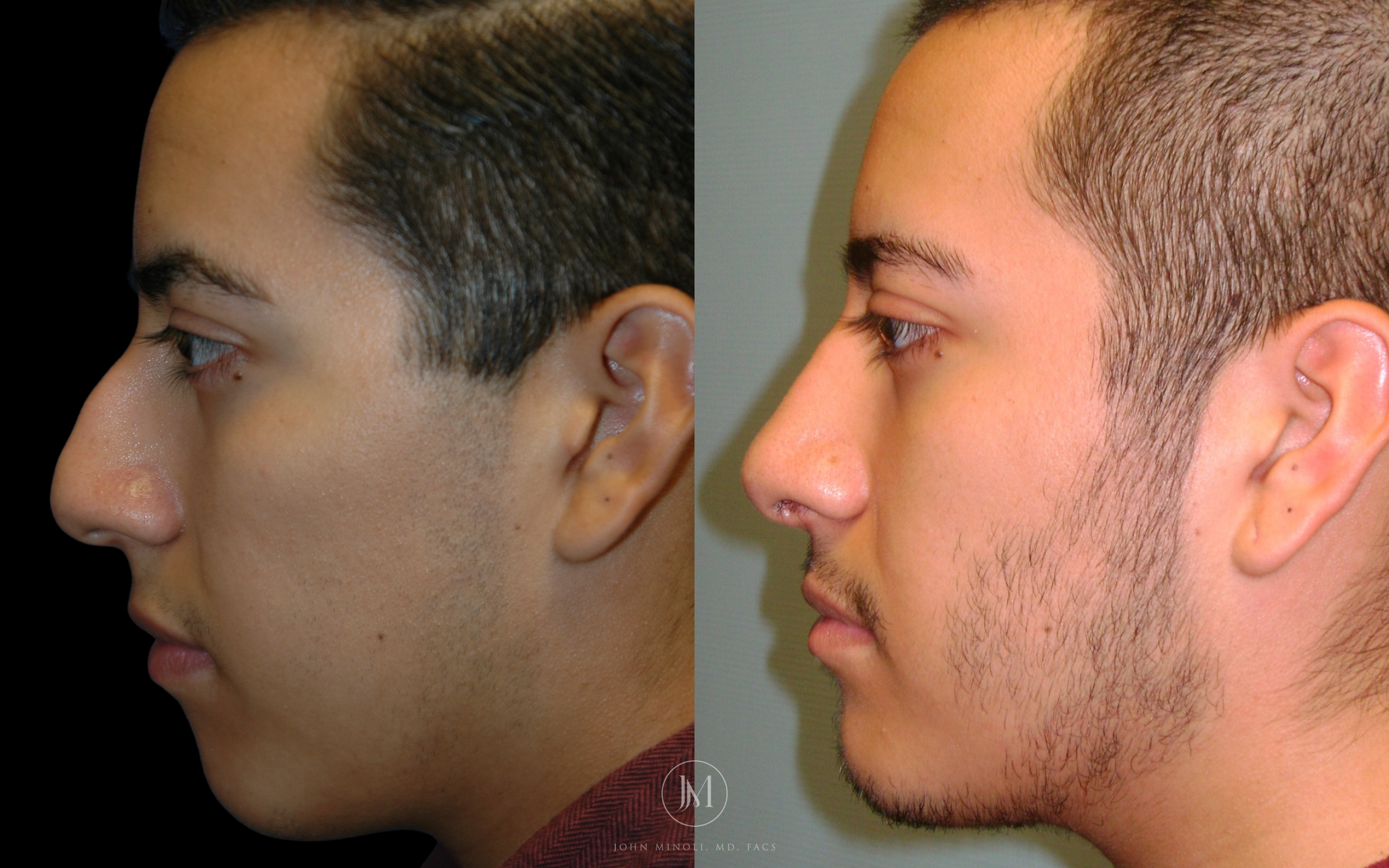 Primary Rhinoplasty before and after