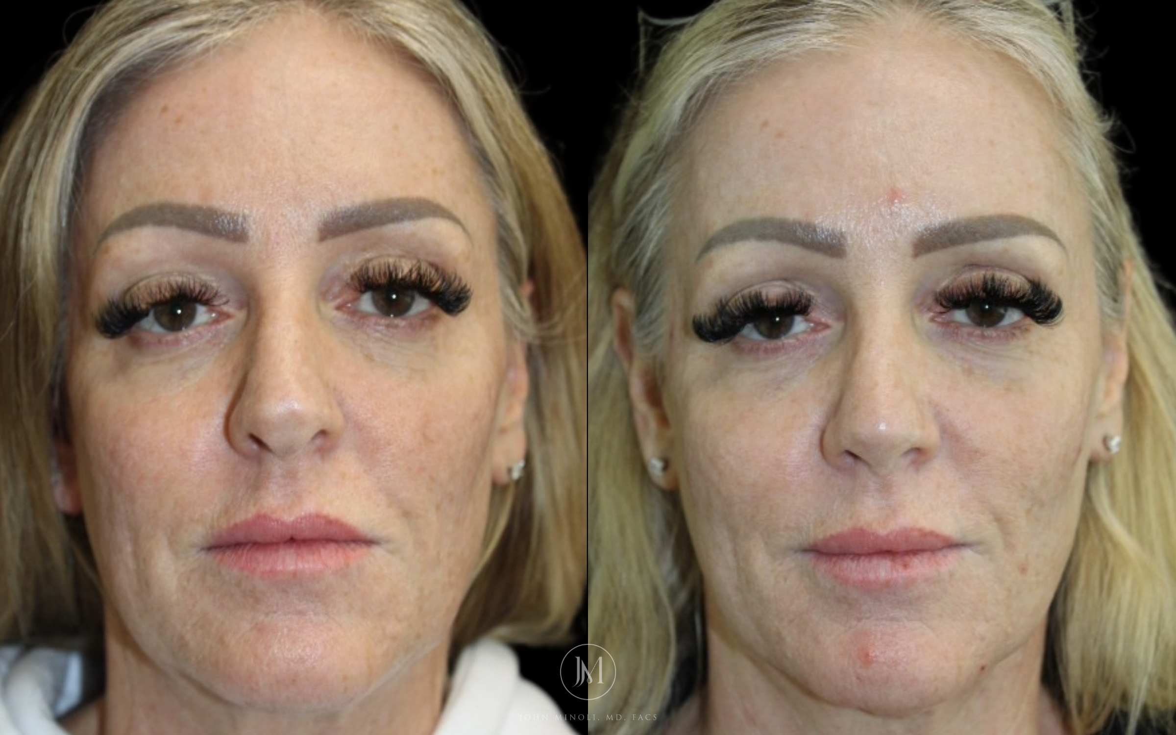 Primary Rhinoplasty Front before and after
