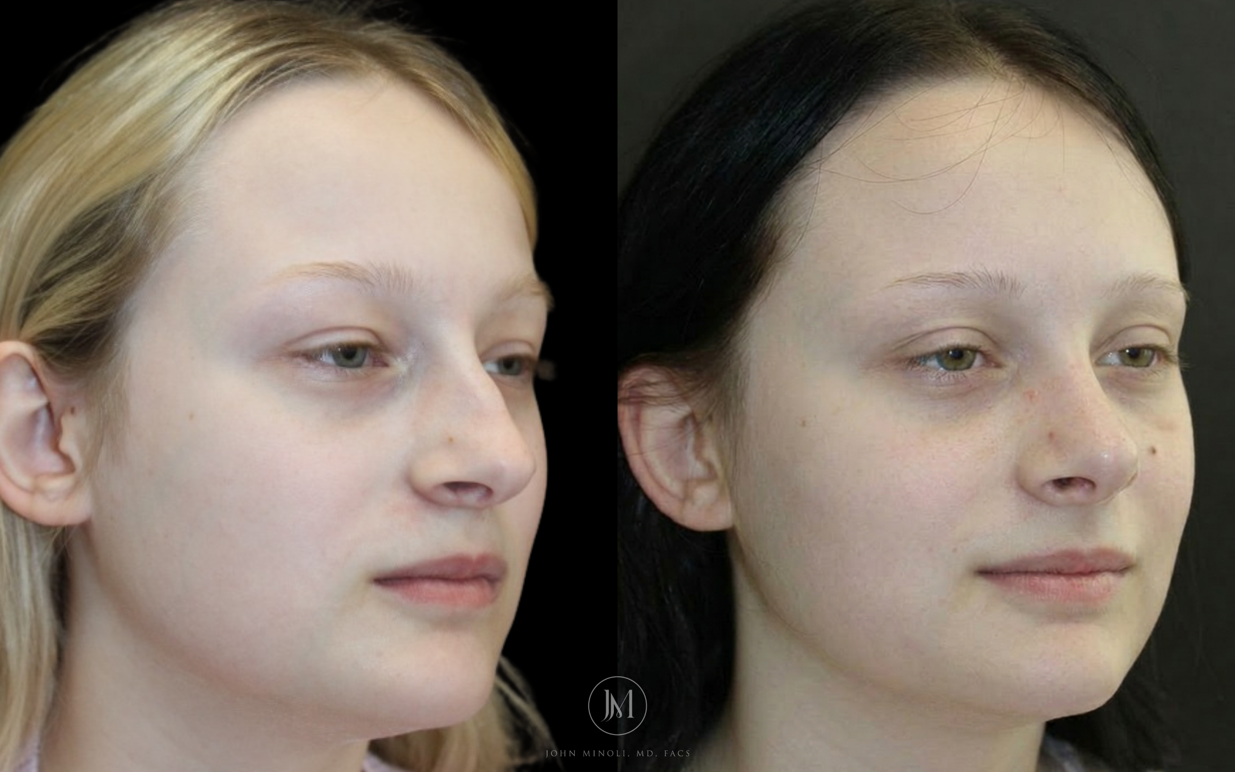 Primary Rhinoplasty before and after