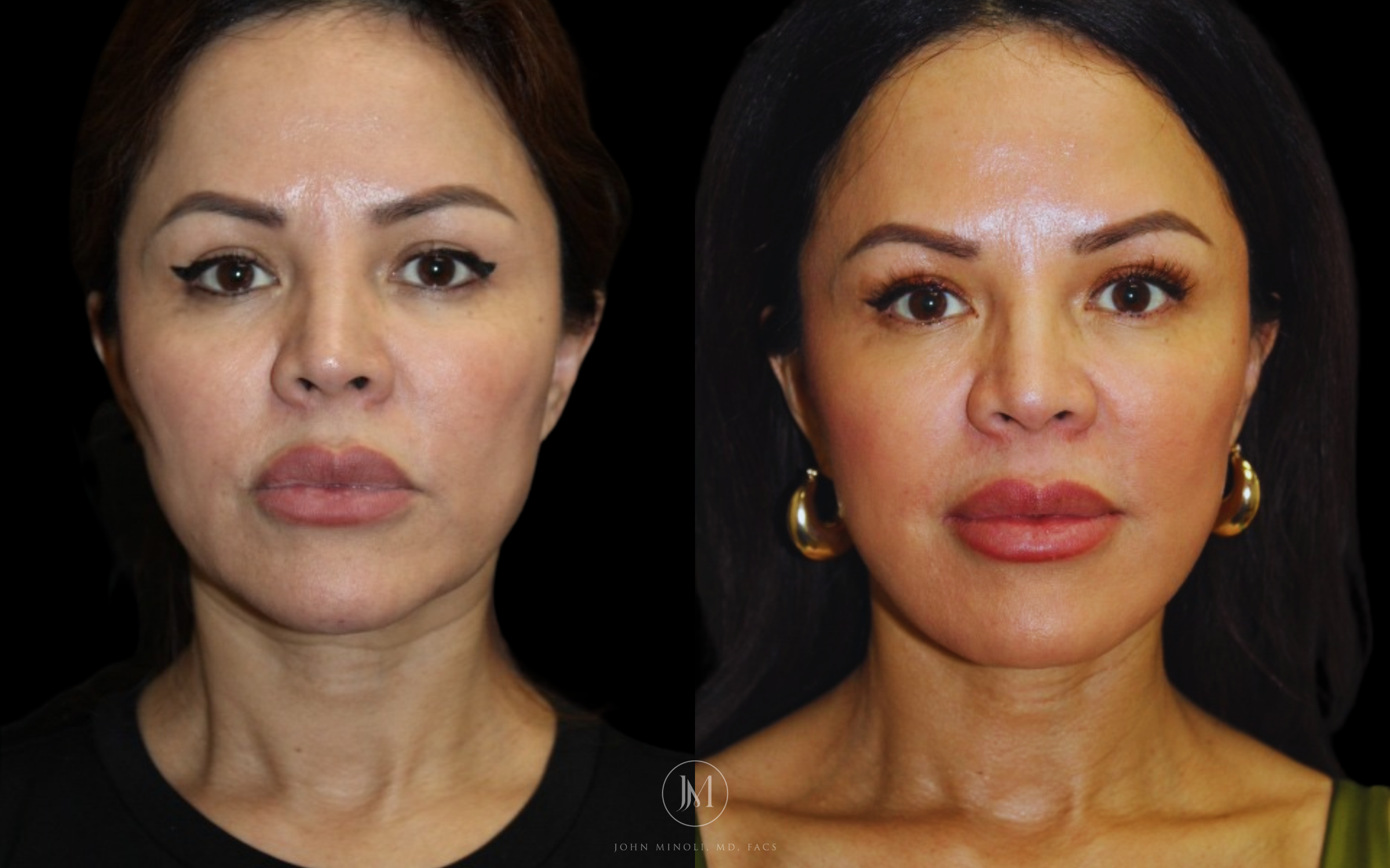 Neck Lift Before and After