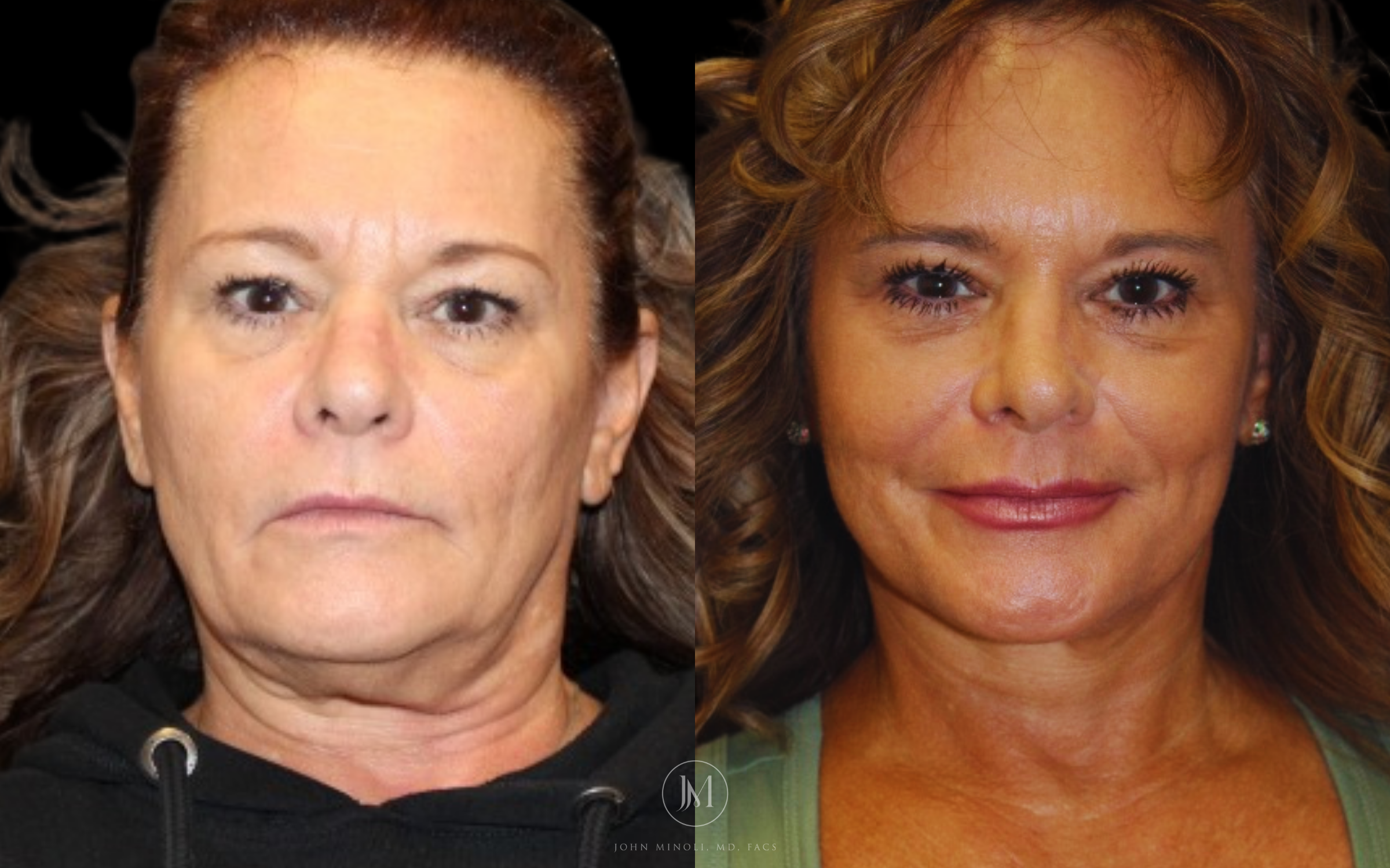 Face and Neck Lift Before and After