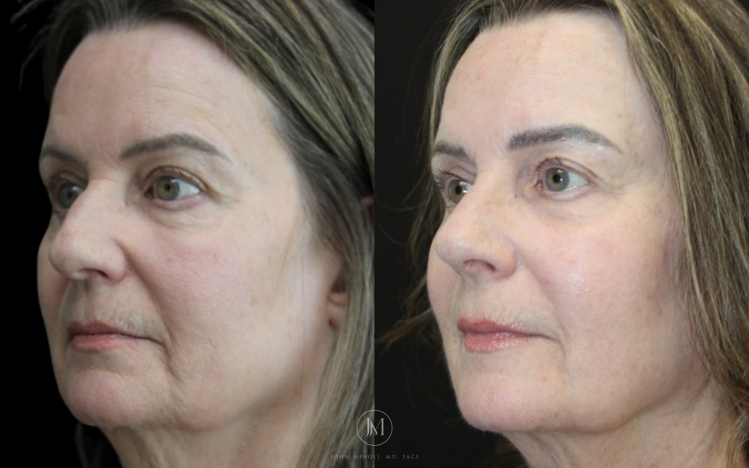 Primary Rhinoplasty before and after