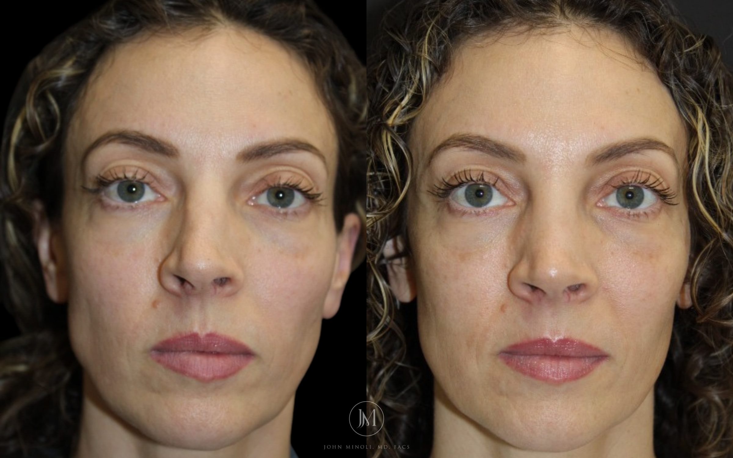 Primary Rhinoplasty before and after