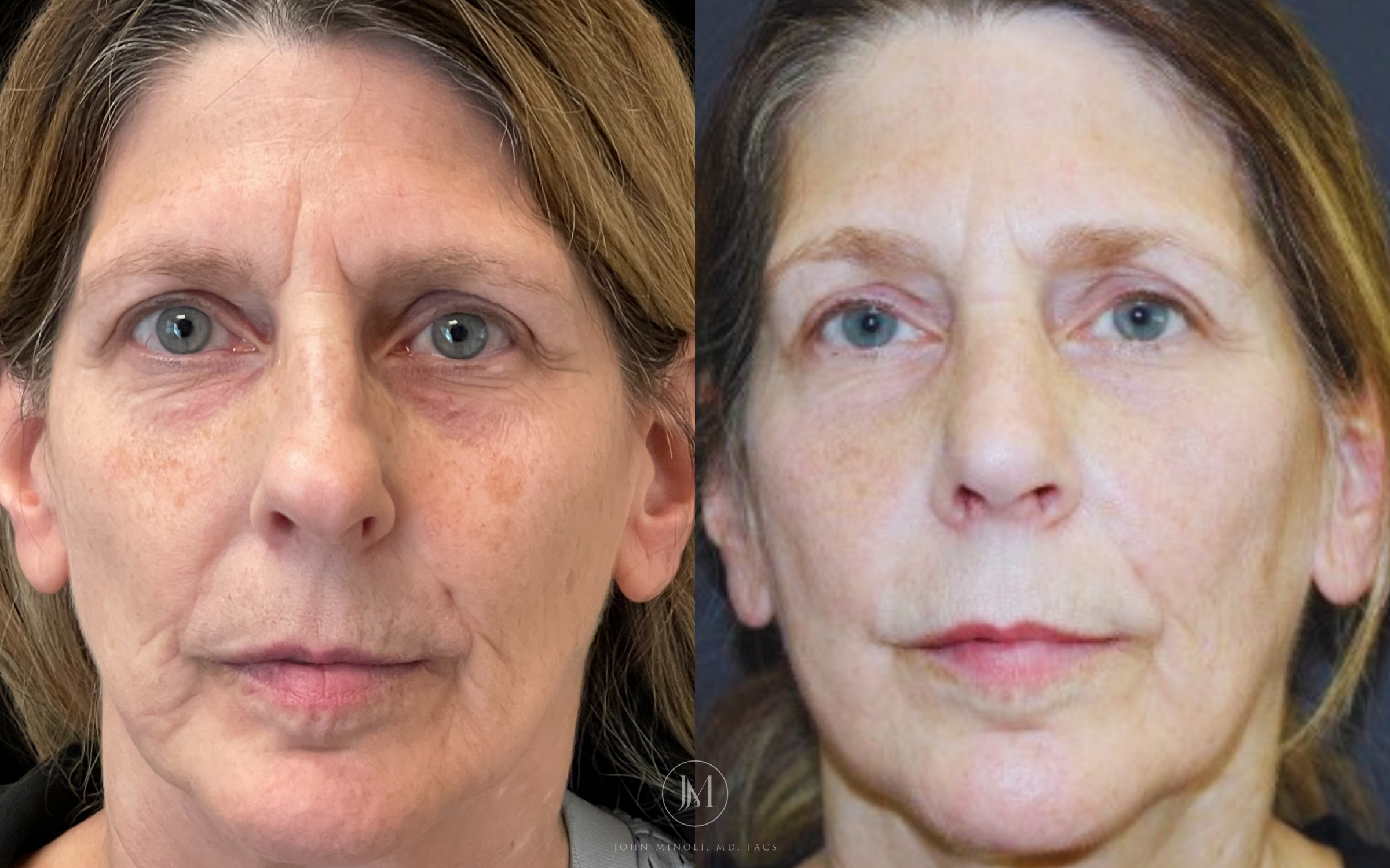 Primary Rhinoplasty before and after