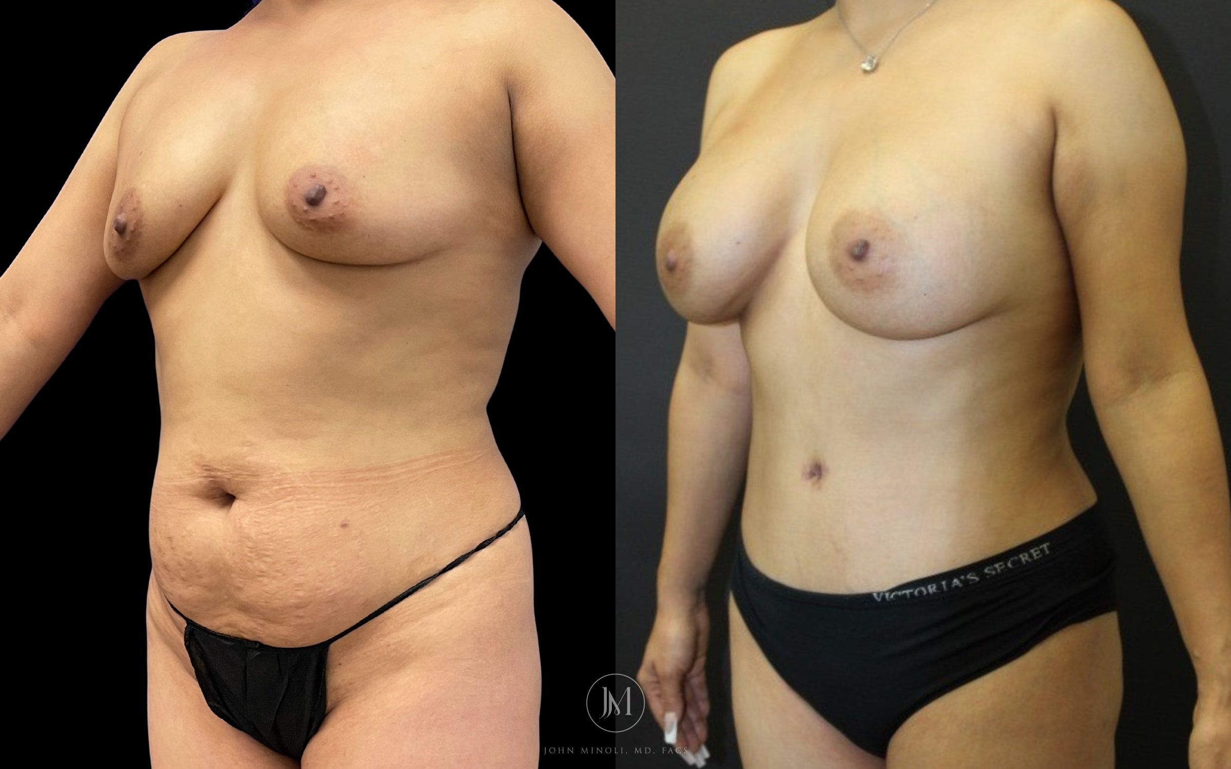 Mommy Make over breast and stomach before and after