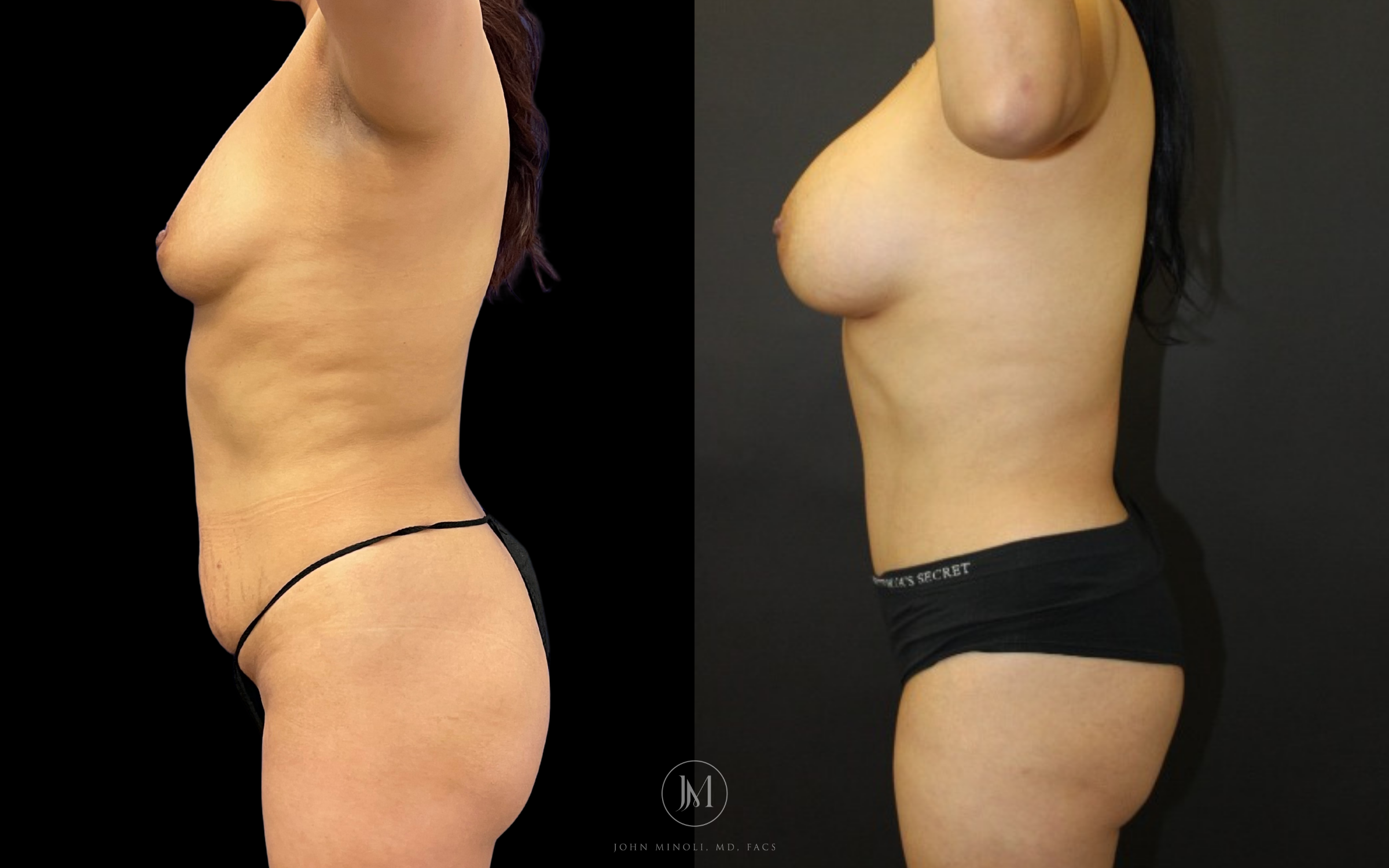 Mommy Make over breast and stomach before and after