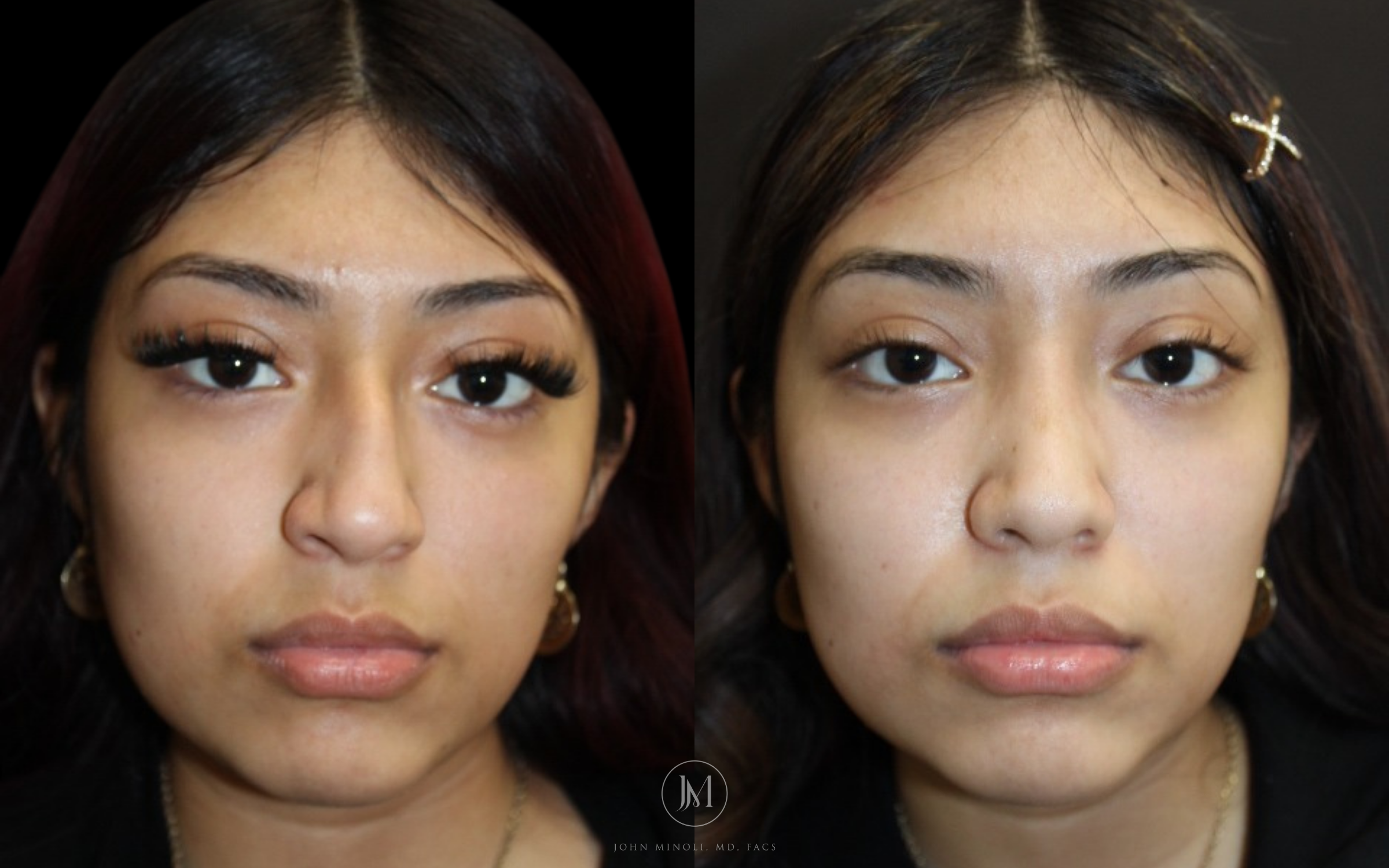 Before and After Primary Rhinoplasty