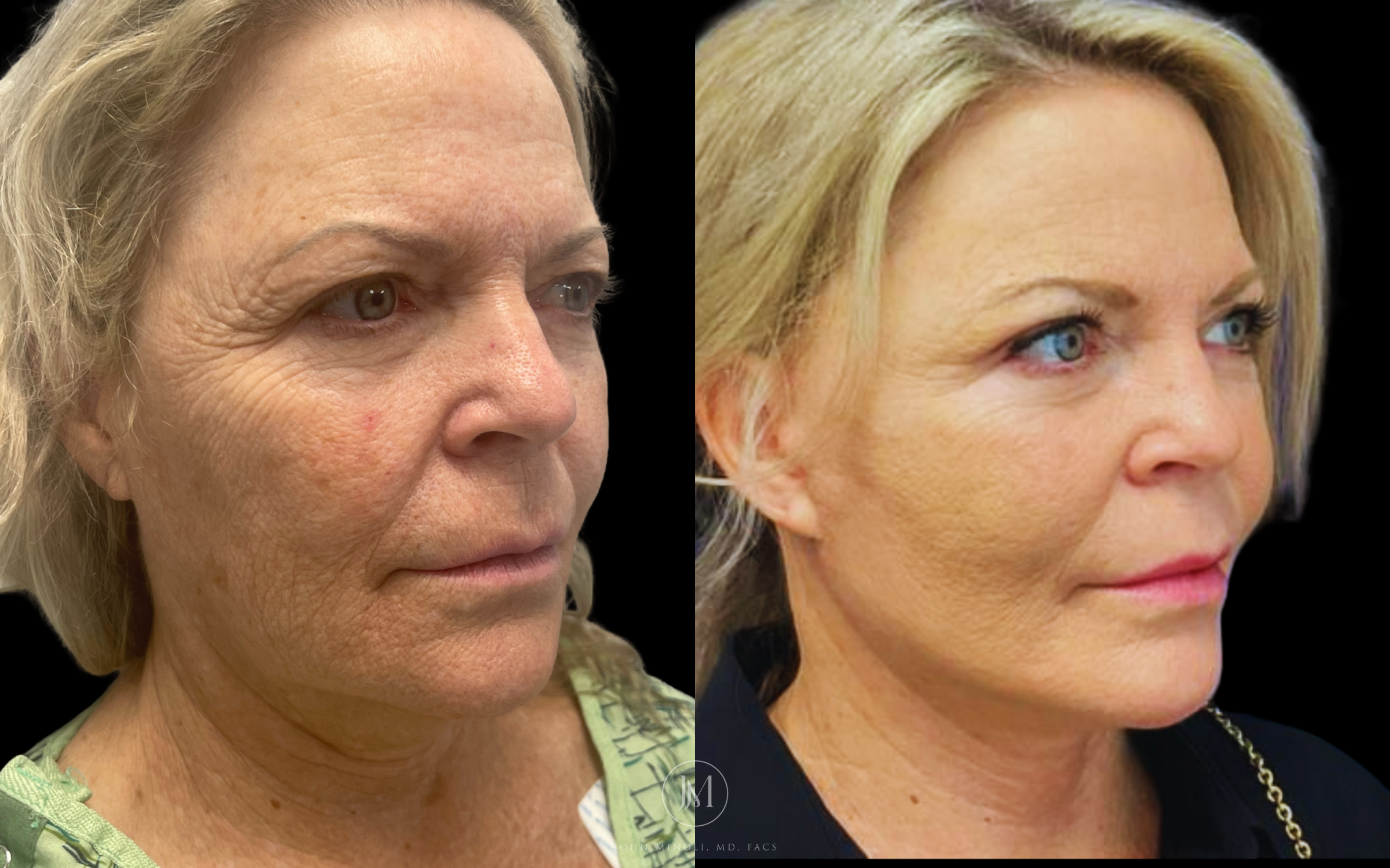 Face and Neck Lift Before and After
