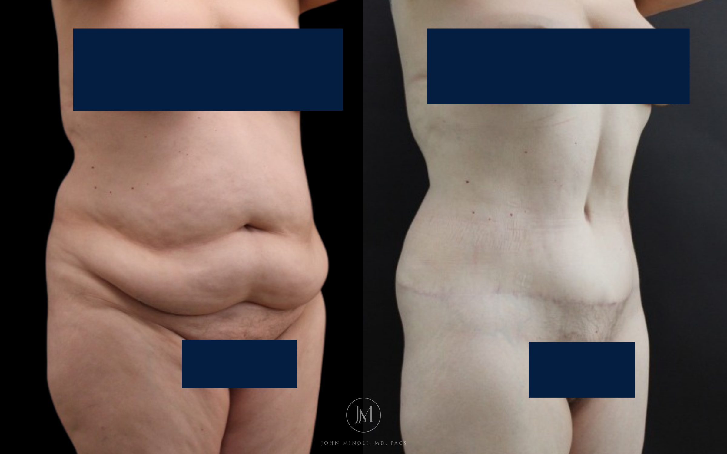 abdominoplasty before and after