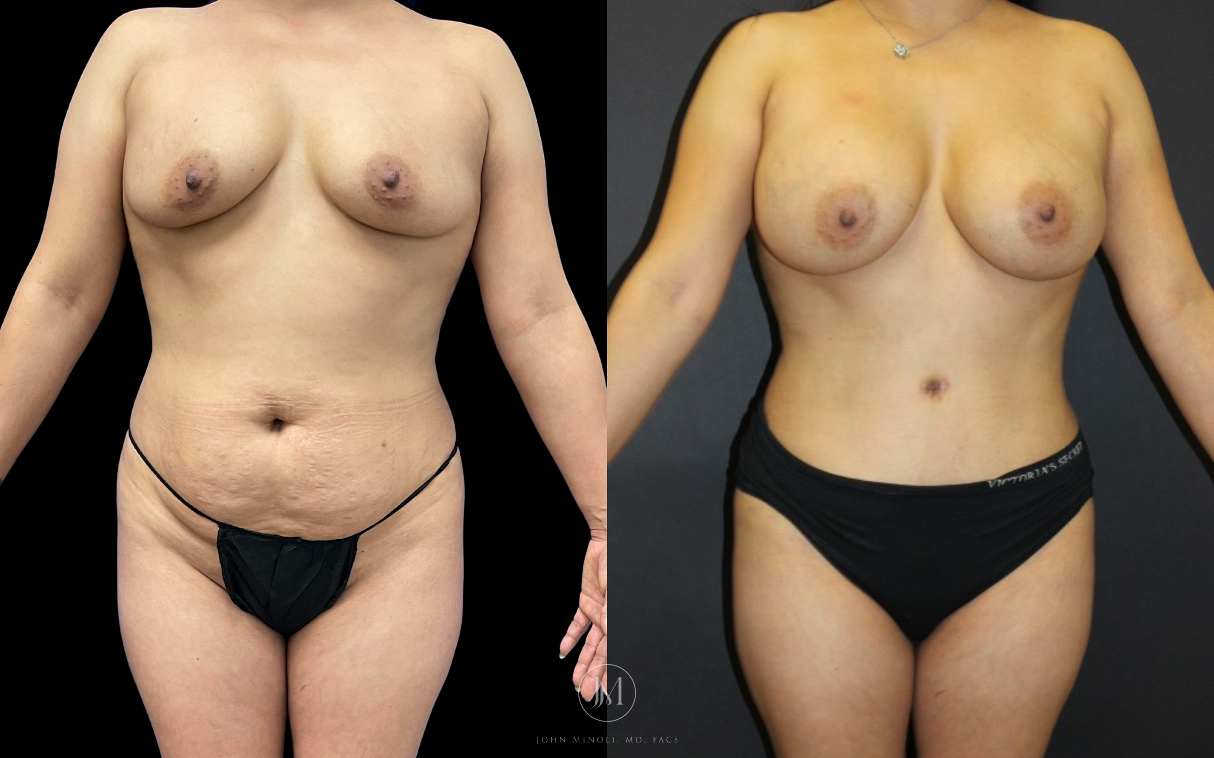 Mommy Make over breast and stomach before and after