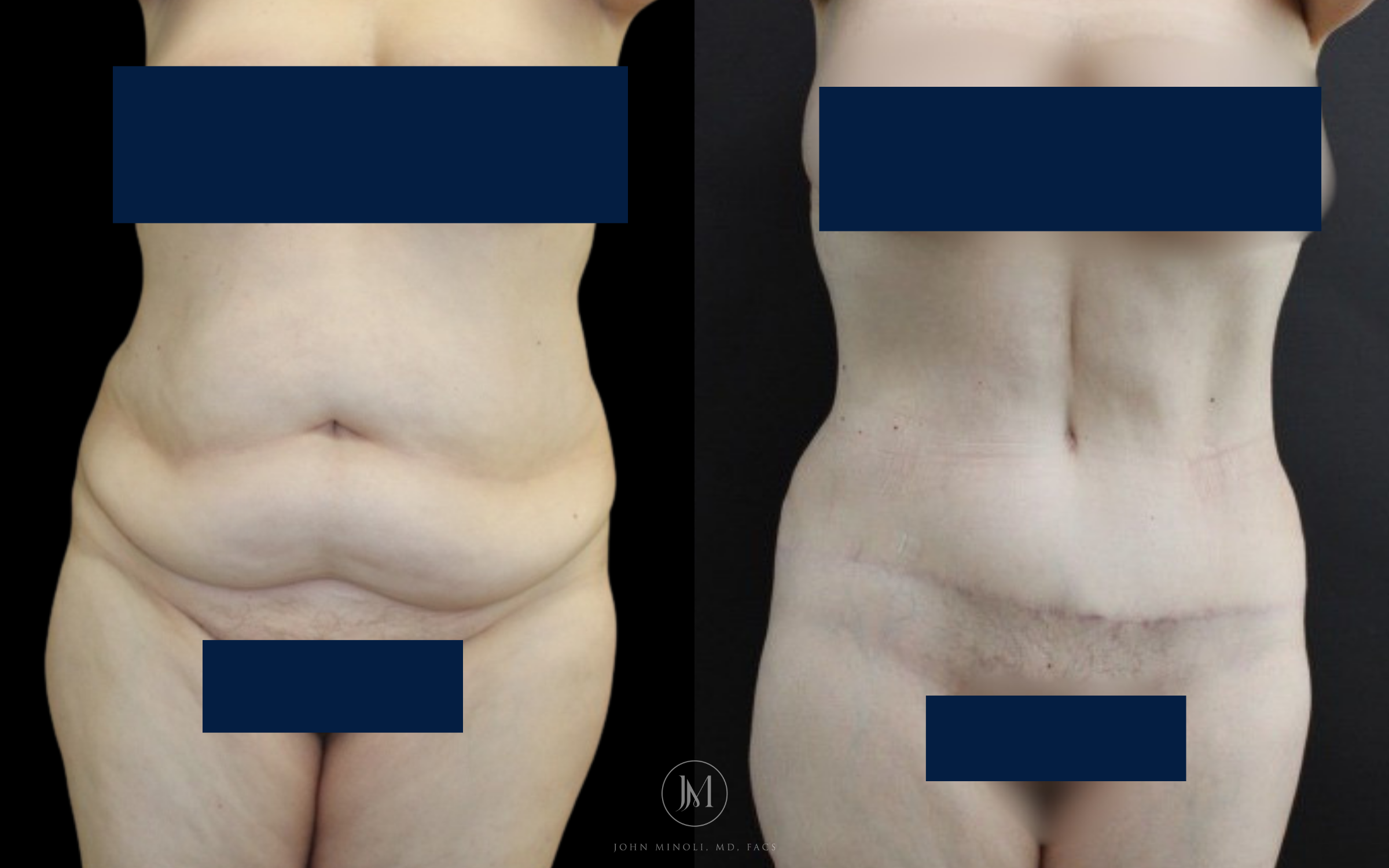 abdominoplasty before and after