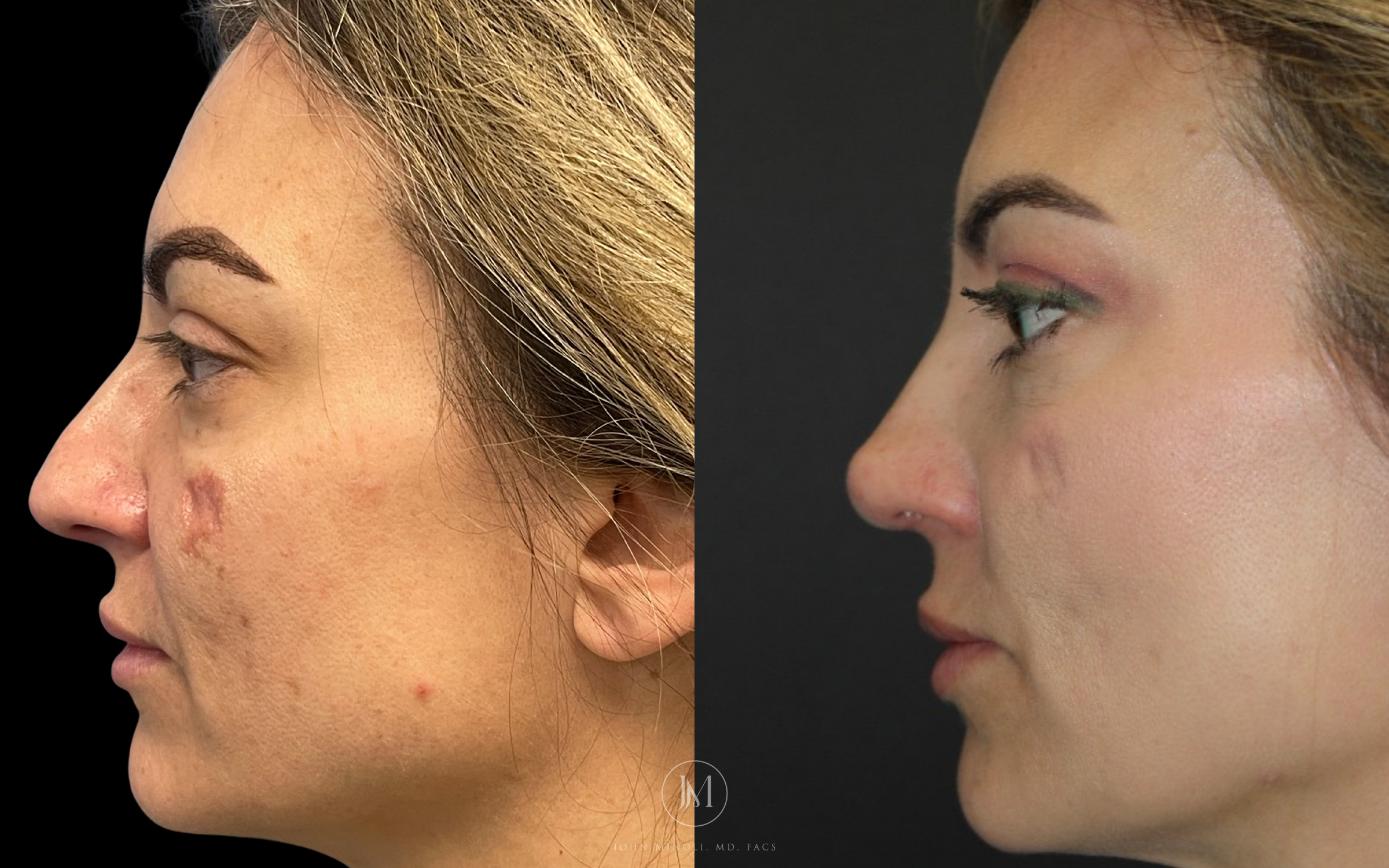 Woman Before and After rhinoplasty