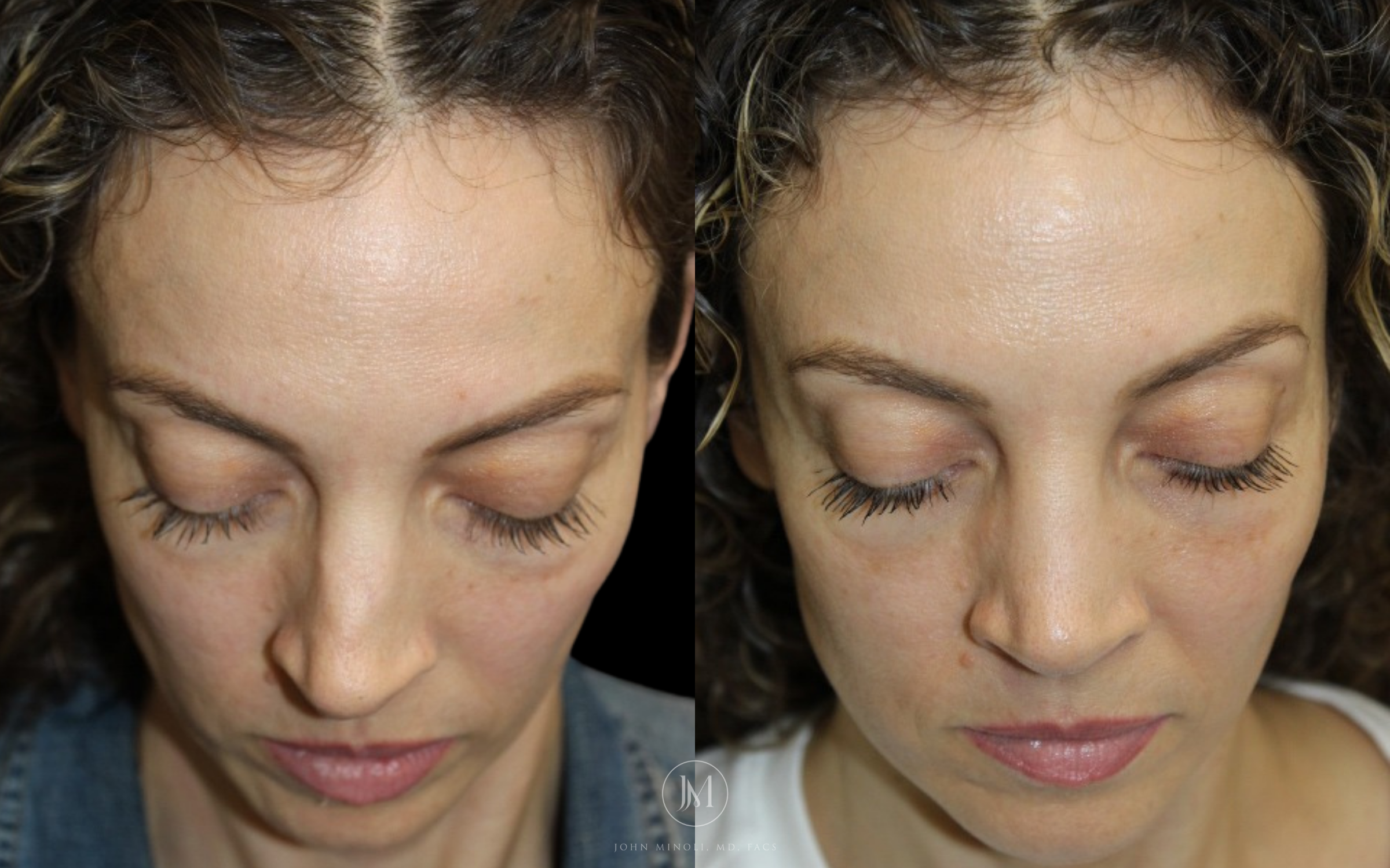Primary Rhinoplasty before and after