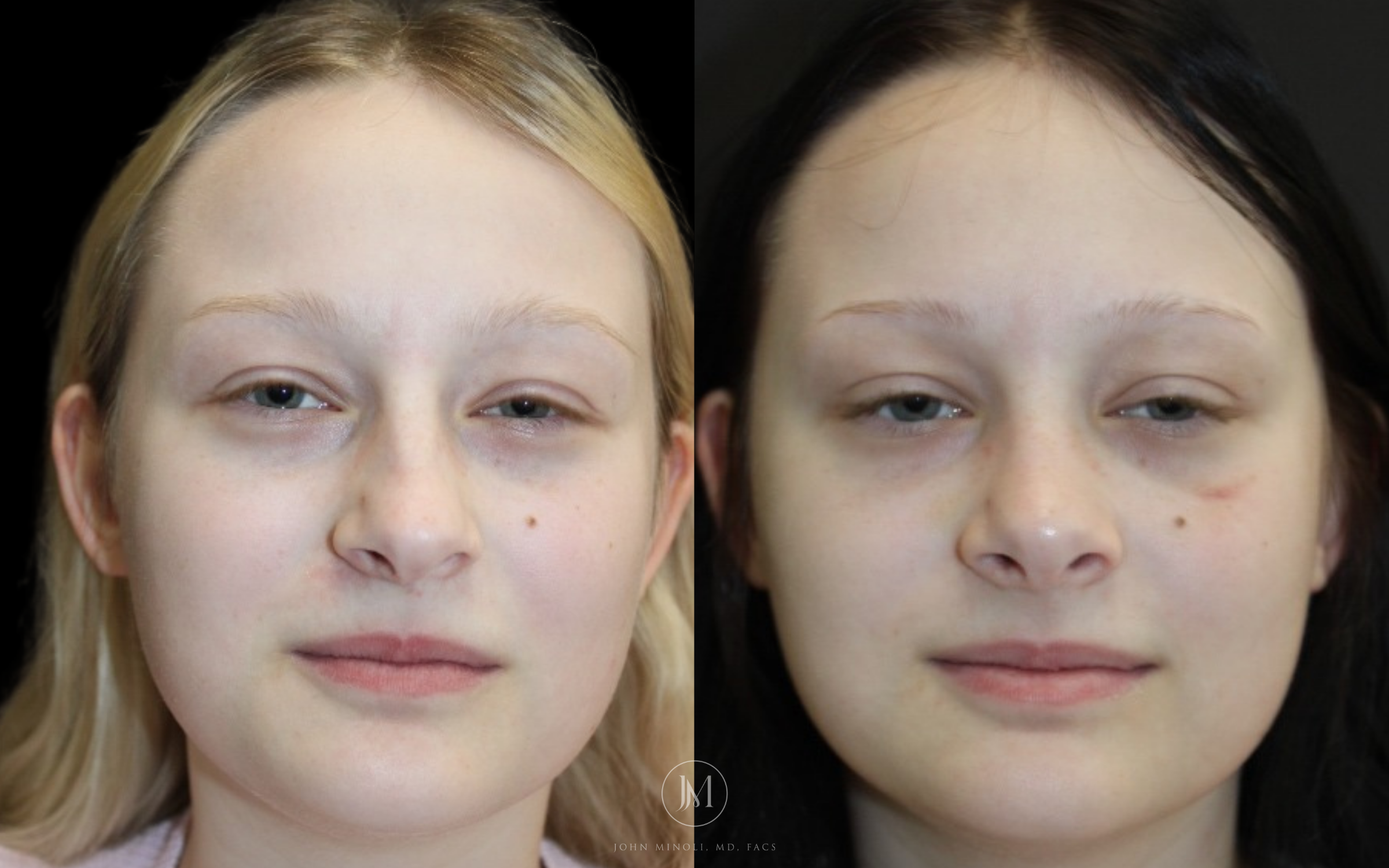 Primary Rhinoplasty before and after