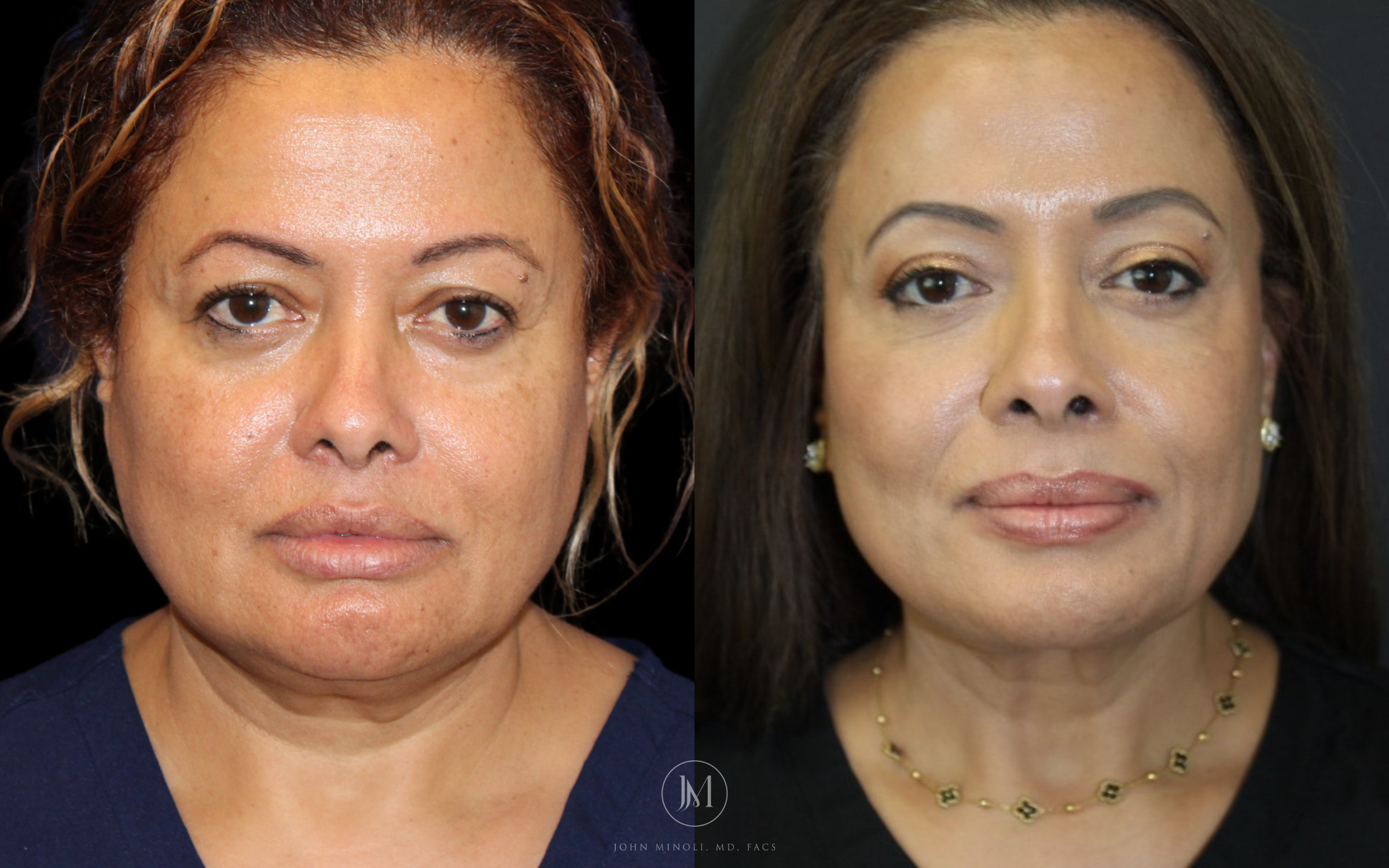 Face and Neck Lift Before and After
