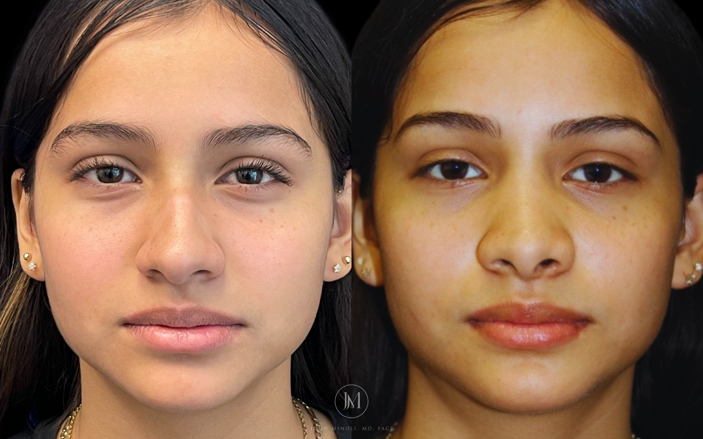 Primary Rhinoplasty before and after front view