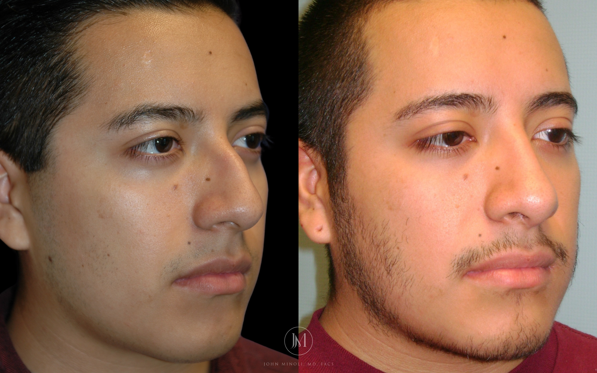 Primary Rhinoplasty before and after