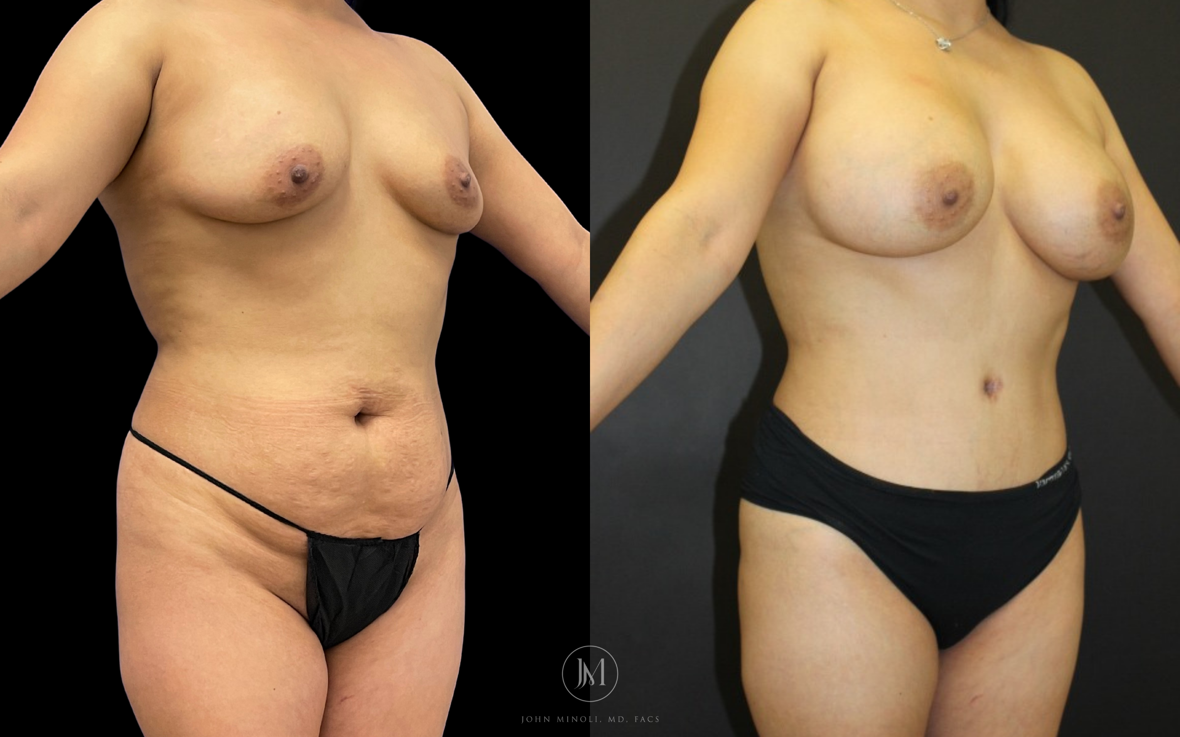 Mommy Make over breast and stomach before and after