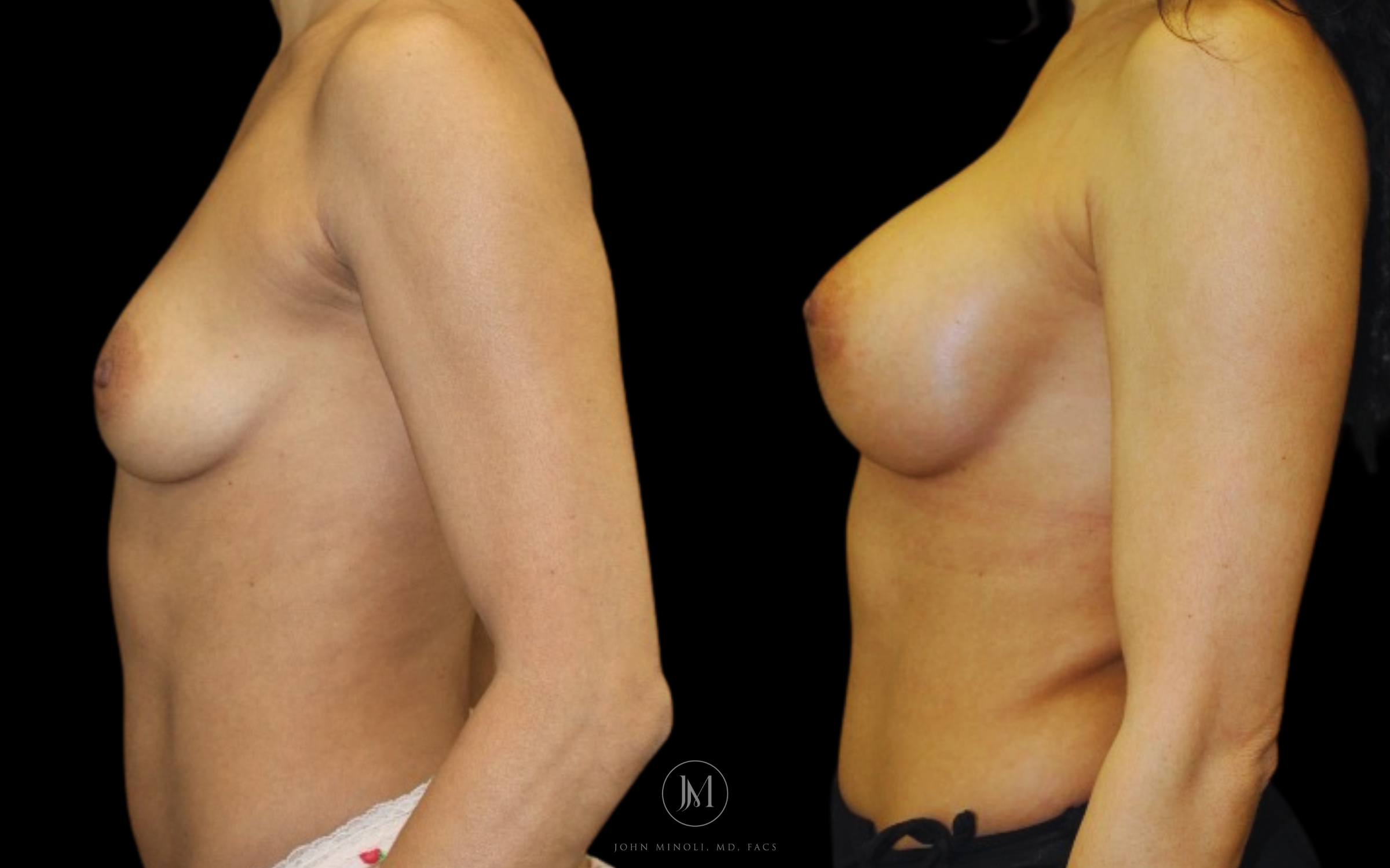 breast augmentation before and after
