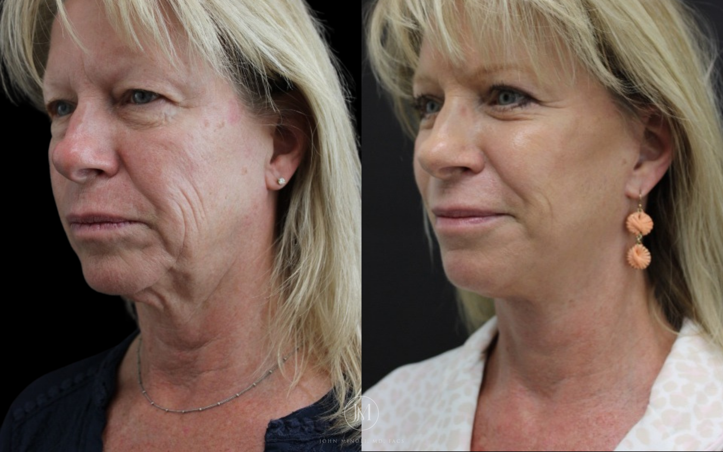 Face and Neck Lift Before and After