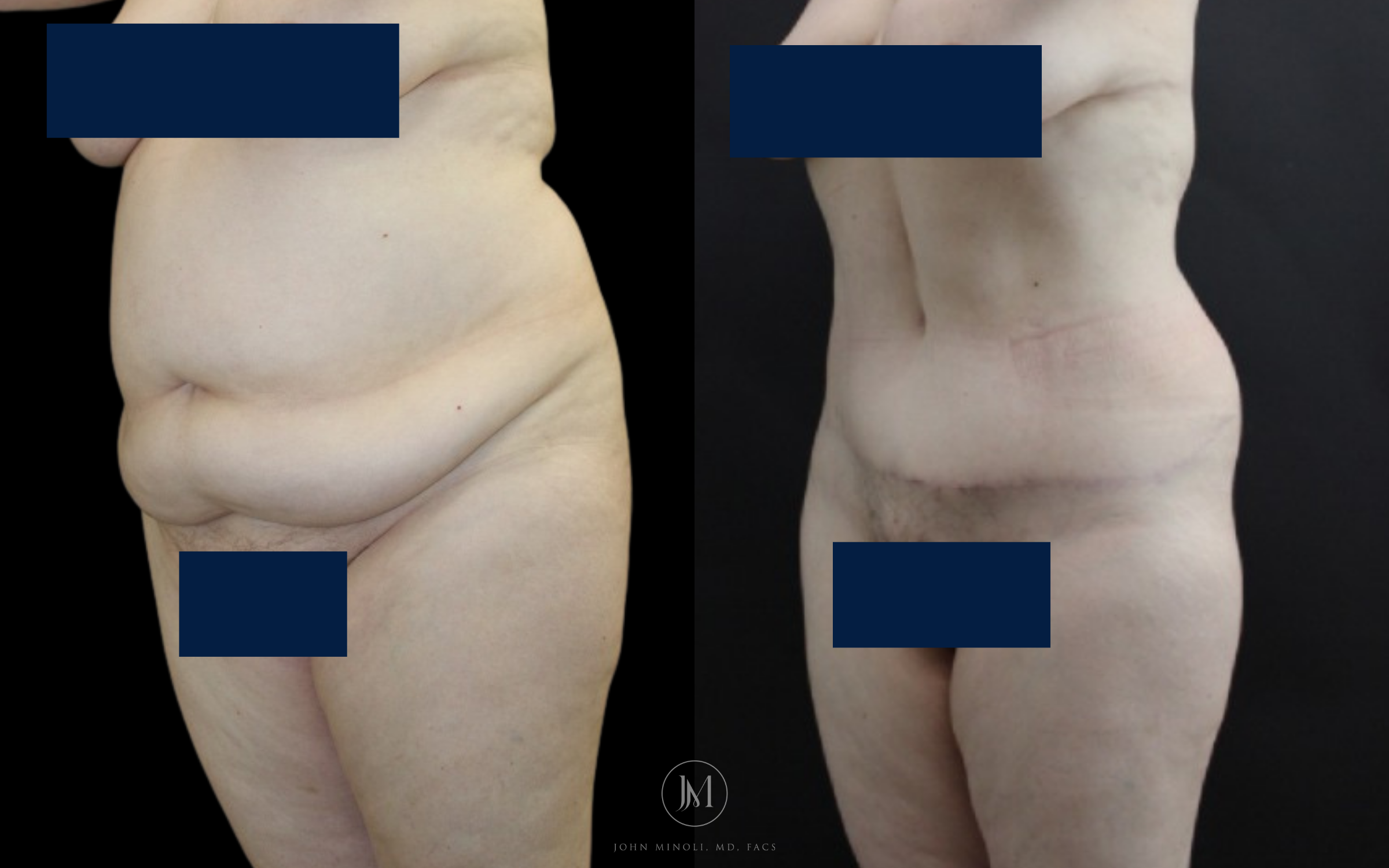 abdominoplasty before and after