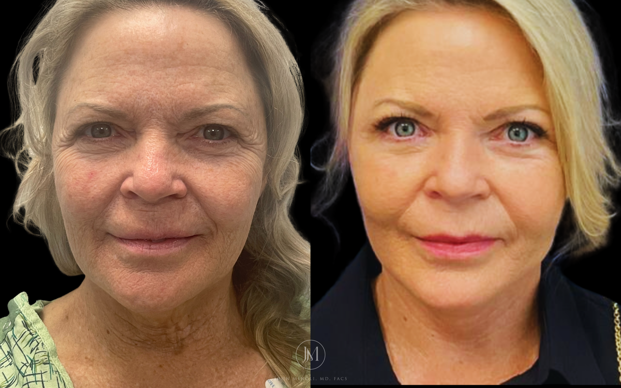 Face and Neck Lift Before and After