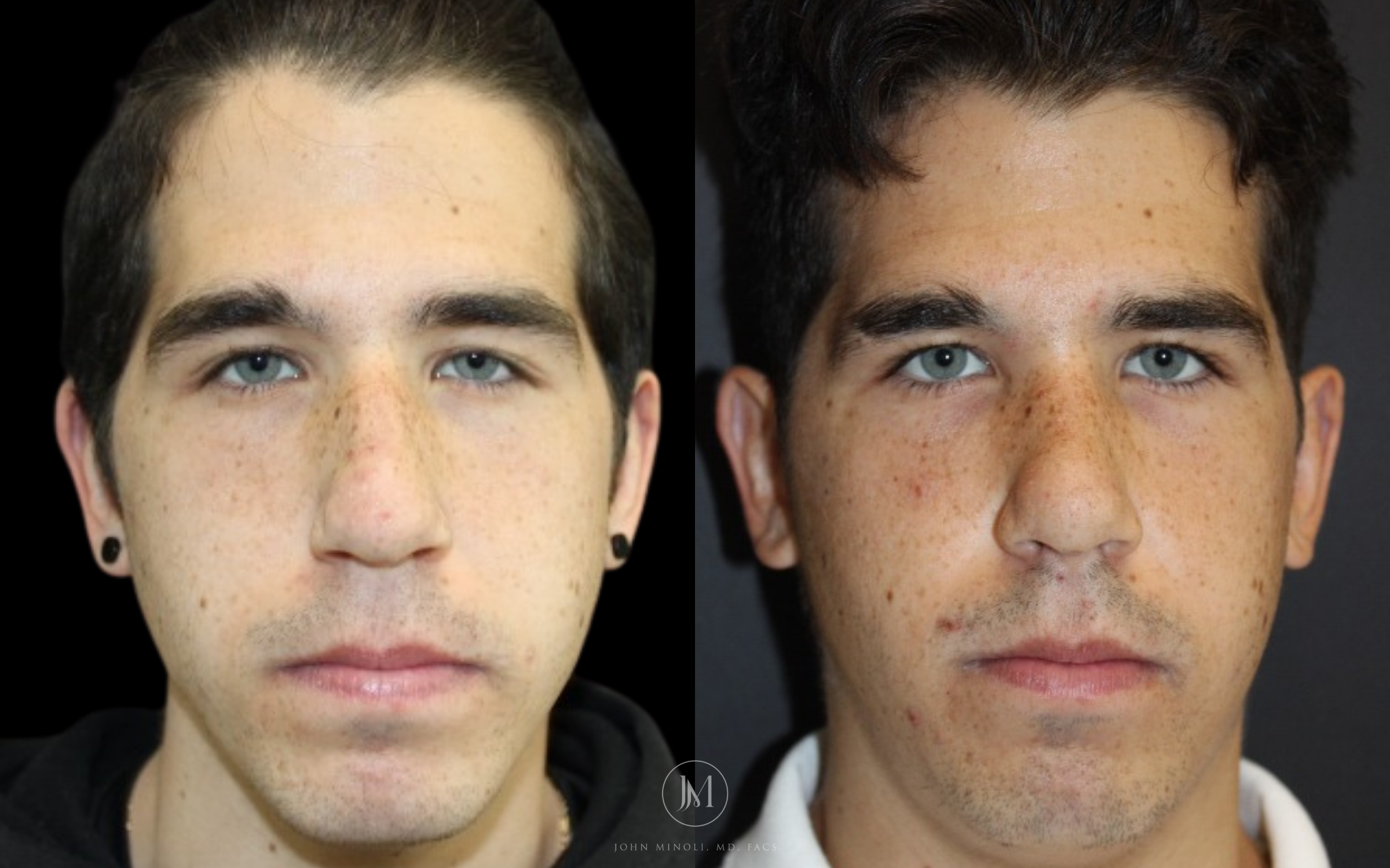 Primary Rhinoplasty before and after