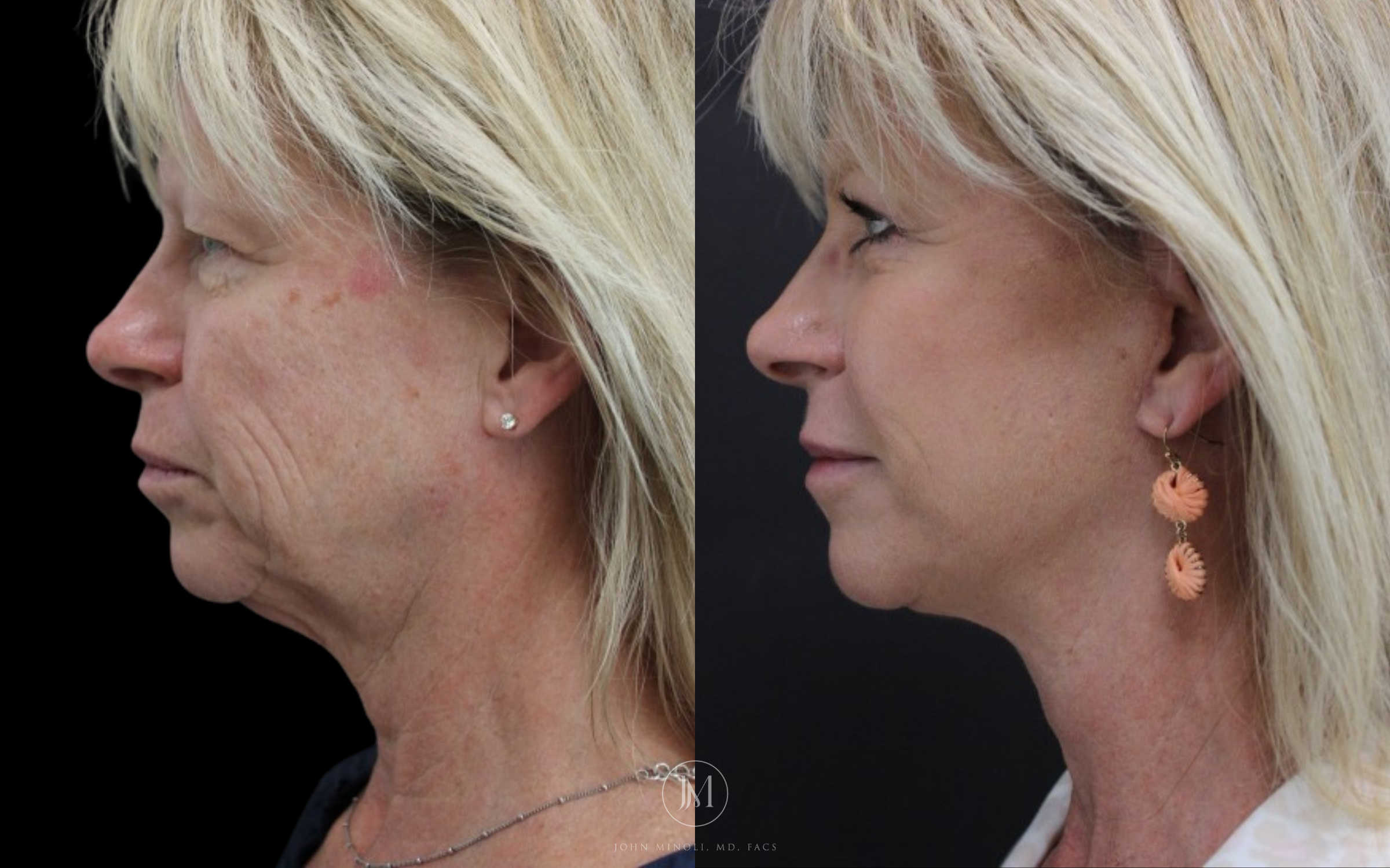 Face and Neck Lift Before and After