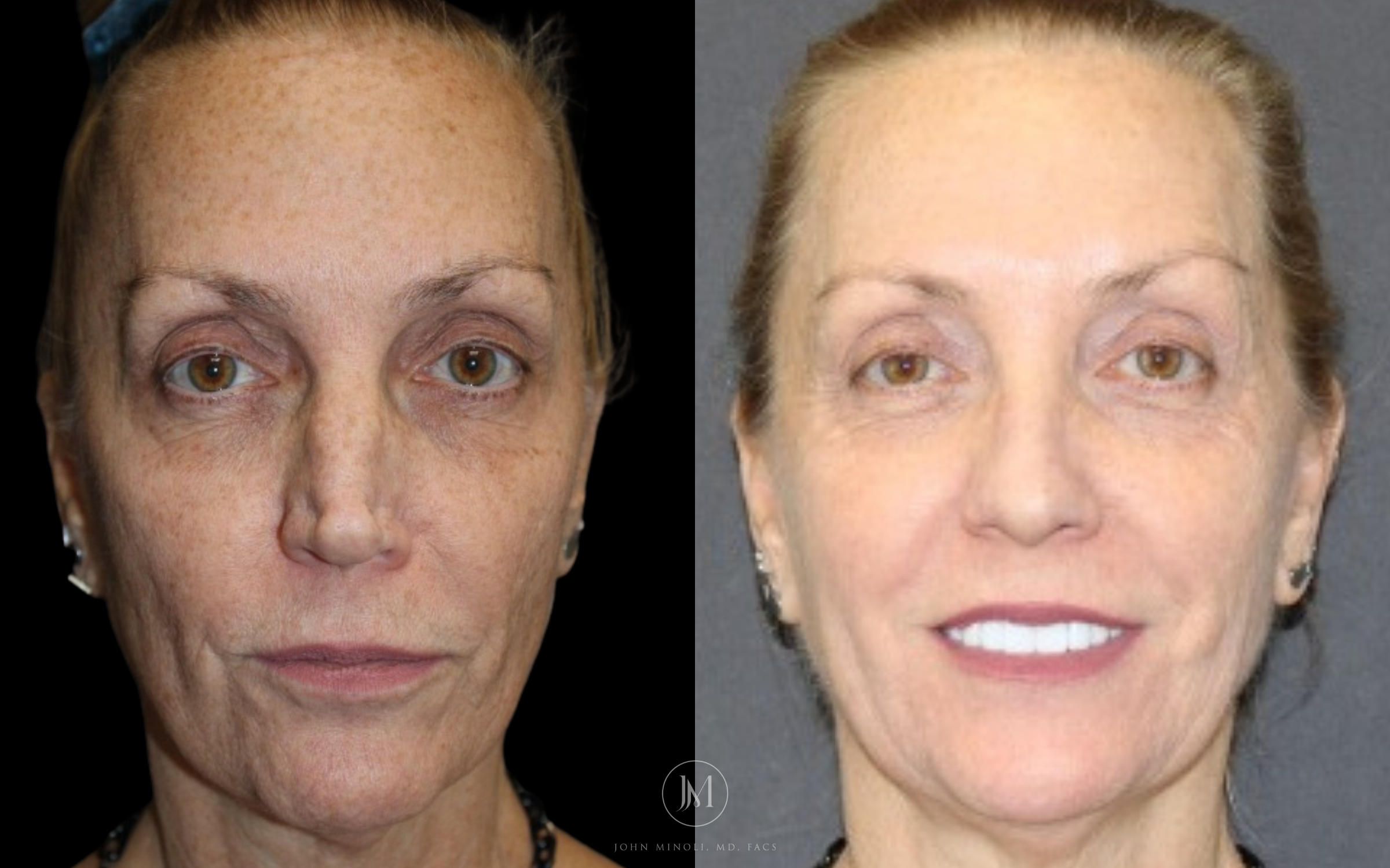 Revision Rhinoplasty Before and After