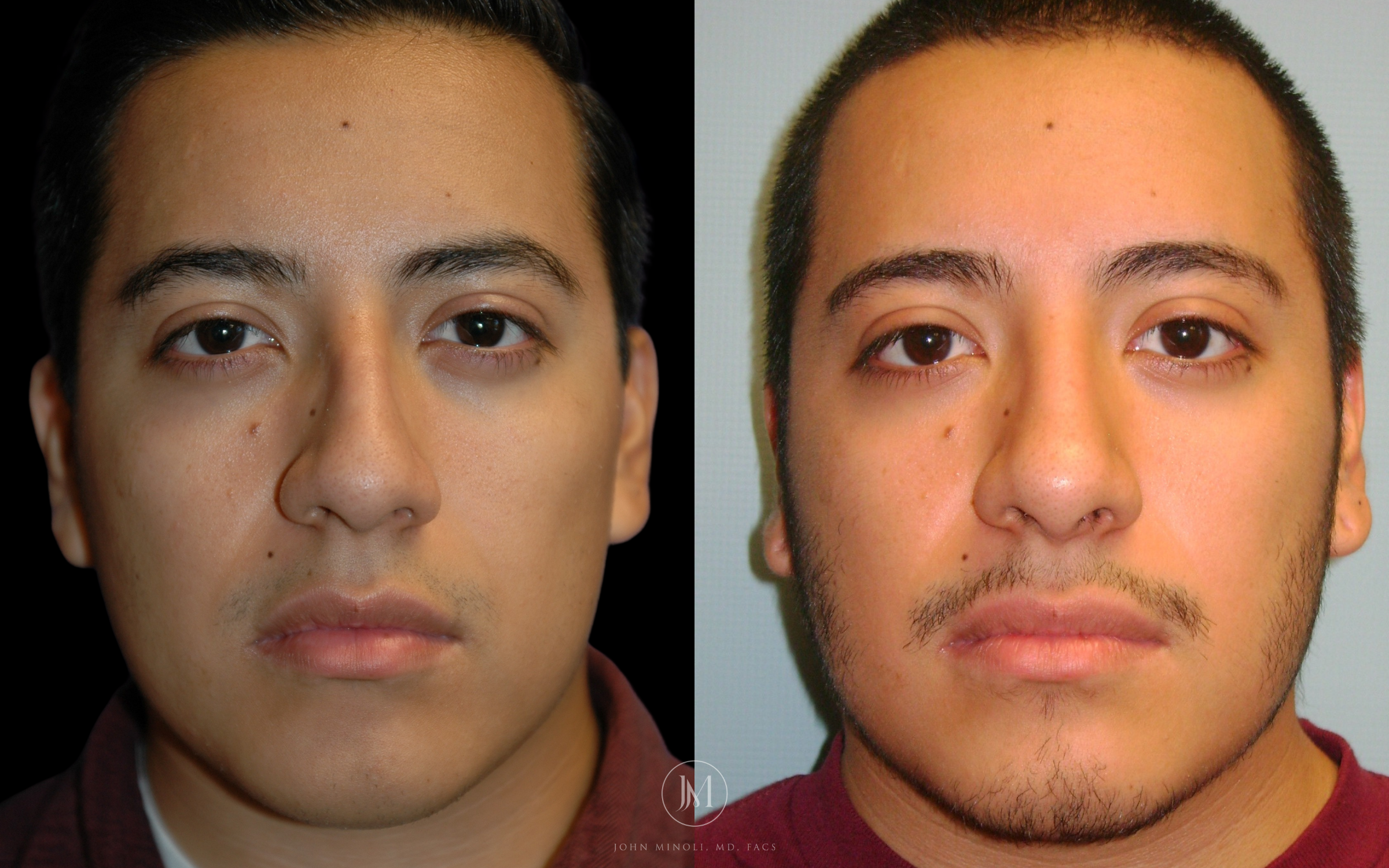Primary Rhinoplasty before and after