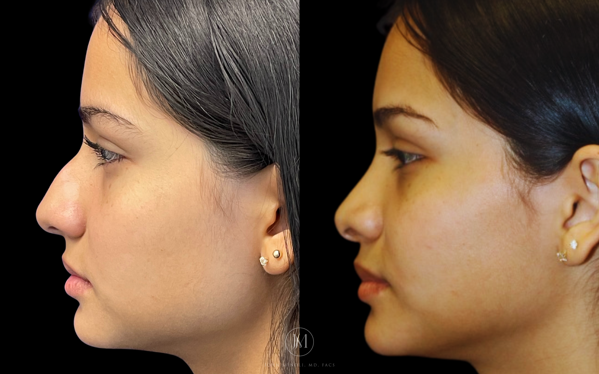 Primary Rhinoplasty before and after
