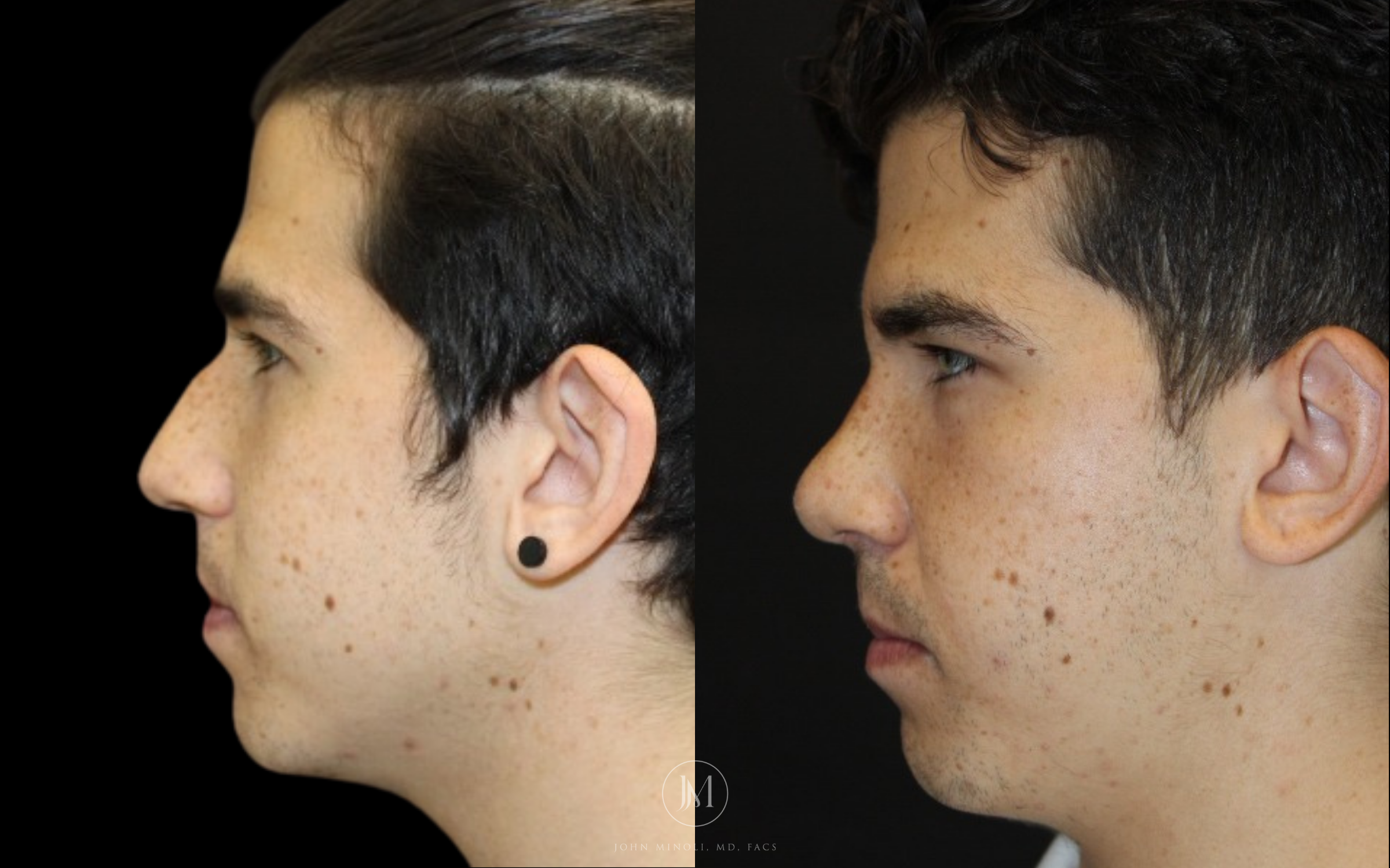 Primary Rhinoplasty before and after