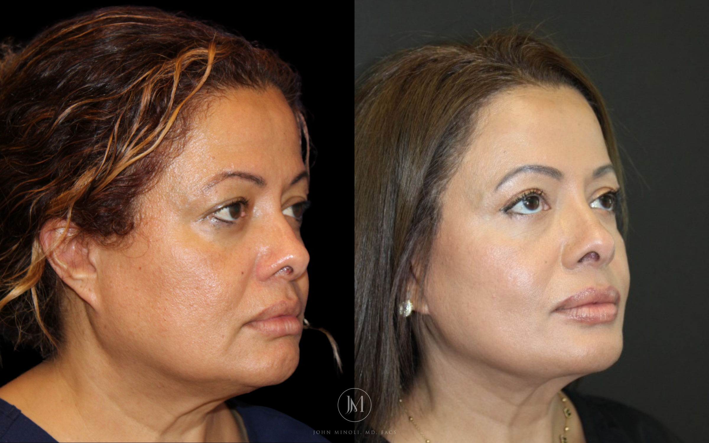 Face and Neck Lift Before and After
