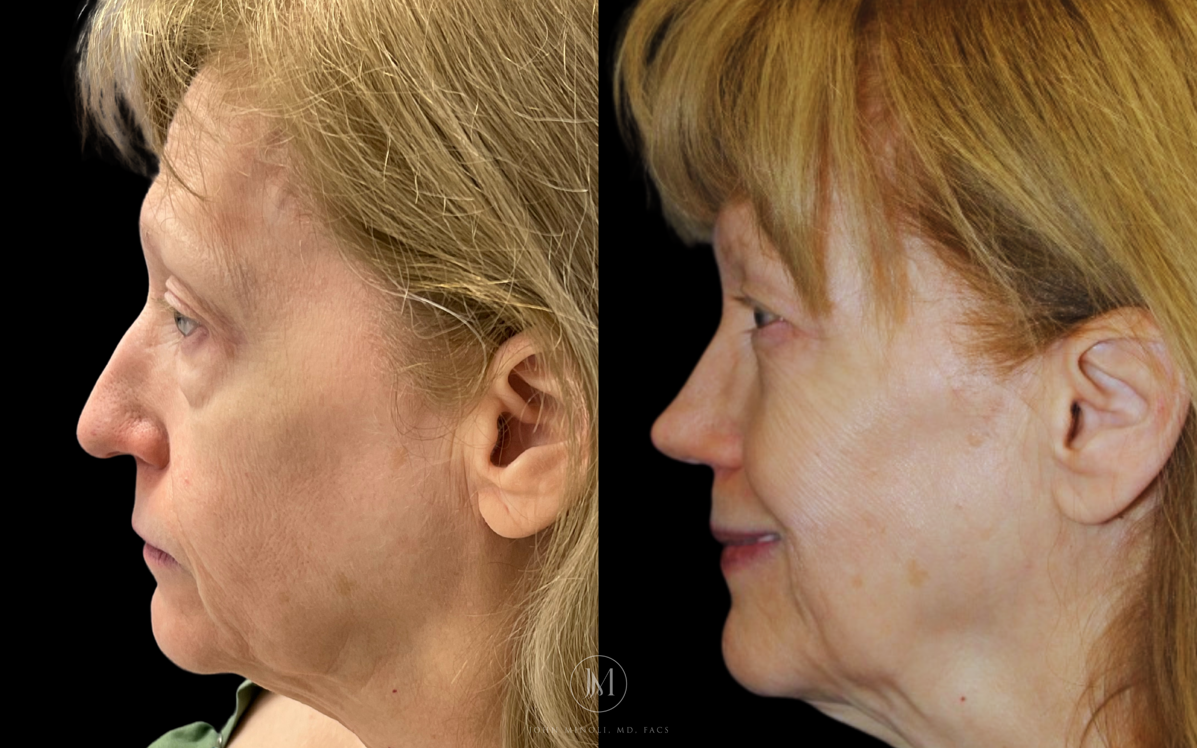 Primary Rhinoplasty before and after